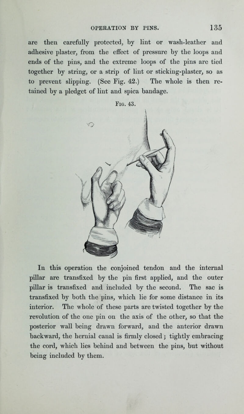are then carefully protected, by lint or wash-leather and adhesive plaster, from the effect of pressure by the loops and ends of the pins, and the extreme loops of the pins are tied together by string, or a strip of lint or sticking-plaster, so as to prevent slipping. (See Fig. 42.) The whole is then re- tained by a pledget of lint and spica bandage. Fig. 43. In this operation the conjoined tendon and the internal pillar are transfixed by the pin first applied, and the outer pillar is transfixed and included by the second. The sac is transfixed by both the pins, which lie for some distance in its interior. The whole of these parts are twisted together by the revolution of the one pin on the axis of the other, so that the posterior wall being drawn forward, and the anterior drawn backward, the hernial canal is firmly closed; tightly embracing the cord, which lies behind and between the pins, but without being included by them.