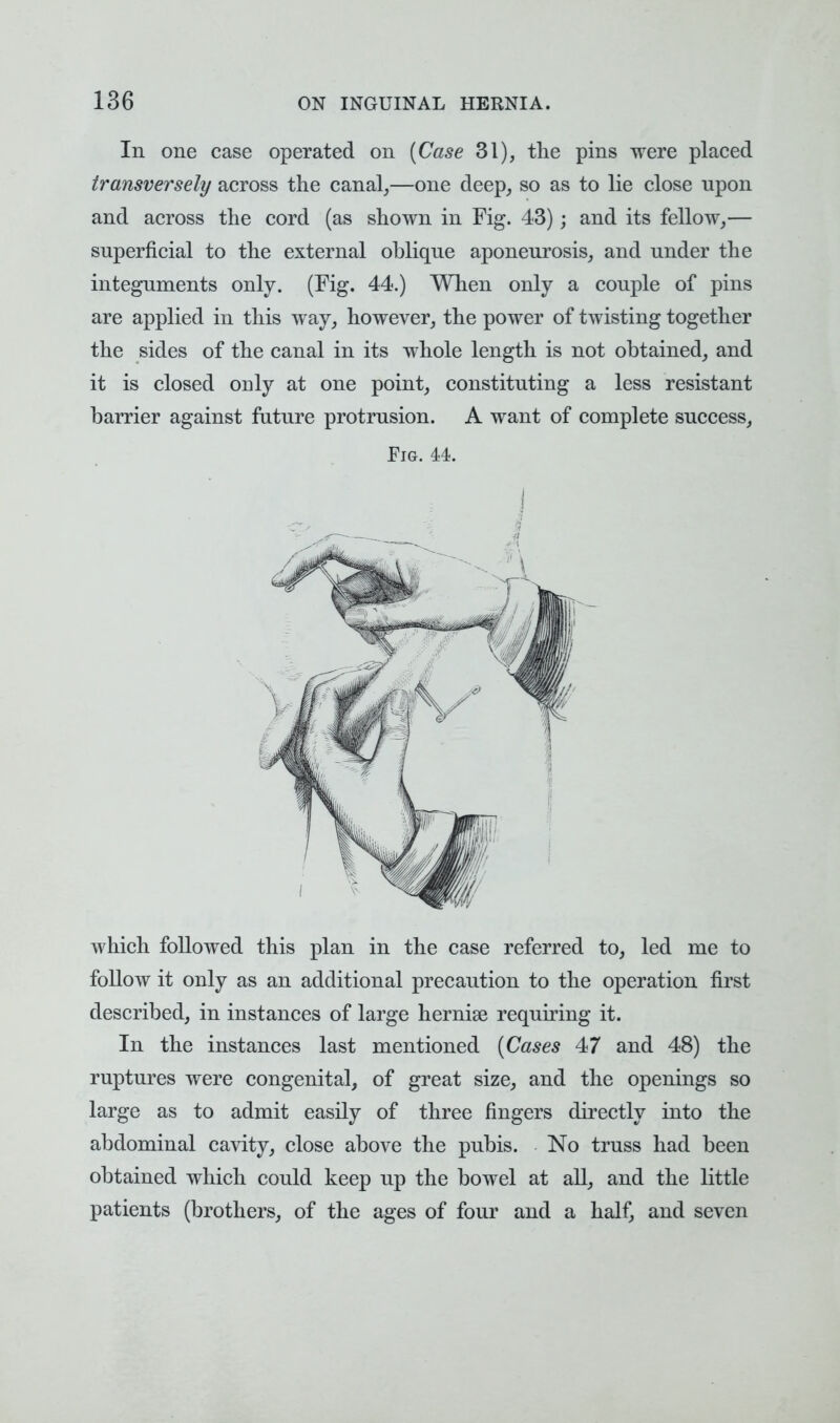 In one case operated on [Case 31), the pins were placed transversely across the canal,—one deep, so as to lie close upon and across the cord (as shown in Fig. 43); and its fellow,— superficial to the external oblique aponeurosis, and under the integuments only. (Fig. 44.) When only a couple of pins are applied in this way, however, the power of twisting together the sides of the canal in its whole length is not obtained, and it is closed only at one point, constituting a less resistant barrier against future protrusion. A want of complete success, Fig. 44. which followed this plan in the case referred to, led me to follow it only as an additional precaution to the operation first described, in instances of large hernise requiring it. In the instances last mentioned (Cases 47 and 48) the ruptures were congenital, of great size, and the openings so large as to admit easily of three fingers directly into the abdominal cavity, close above the pubis. No truss had been obtained which could keep up the bowel at all, and the little patients (brothers, of the ages of four and a half, and seven