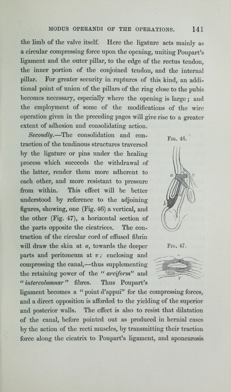 Pig. 46. the limb of the valve itself. Here the ligature acts mainly as a circular compressing force upon the opening, uniting Poupart's ligament and the outer pillar, to the edge of the rectus tendon, the inner portion of the conjoined tendon, and the internal pillar. For greater security in ruptures of this kind, an addi- tional point of union of the pillars of the ring close to the pubis becomes necessary, especially where the opening is large; and the employment of some of the modifications of the wire operation given in the preceding pages will give rise to a greater extent of adhesion and consolidating action. Secondly.—The consolidation and con- traction of the tendinous structures traversed by the ligature or pins under the healing process which succeeds the withdrawal of the latter, render them more adherent to each other, and more resistant to pressure from within. This effect will be better understood by reference to the adjoining figures, showing, one (Fig. 46) a vertical, and the other (Fig. 47), a horizontal section of the parts opposite the cicatrices. The con- traction of the circular cord of effused fibrin will draw the skin at a, towards the deeper parts and peritoneum at v; enclosing and compressing the canal,—thus supplementing the retaining power of the  arciform and  intercolumnar; fibres. Thus Poupart's ligament becomes a  point d'appui for the compressing forces, and a direct opposition is afforded to the yielding of the superior and posterior walls. The effect is also to resist that dilatation of the canal, before pointed out as produced in hernial cases by the action of the recti muscles, by transmitting their traction force along the cicatrix to Poupart's ligament, and aponeurosis Pig. 47.