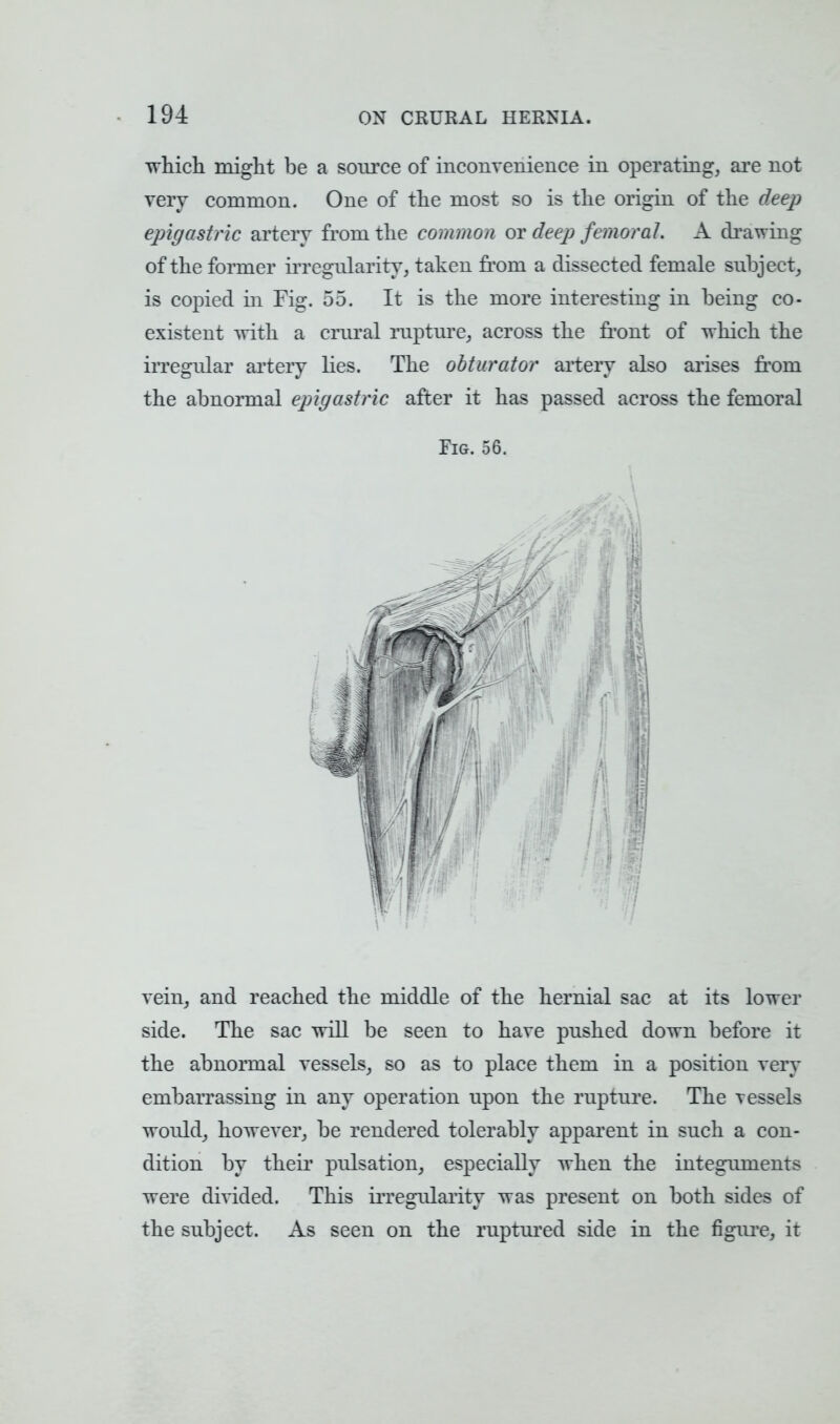 which might be a source of inconvenience in operating, are not very common. One of the most so is the origin of the deep epigastric artery from the common or deep femoral. A drawing of the former irregularity, taken from a dissected female subject, is copied in Fig. 55. It is the more interesting in being co- existent with a crural rupture, across the front of which the irregular artery lies. The obturator artery also arises from the abnormal epigastric after it has passed across the femoral Fig. 56. vein, and reached the middle of the hernial sac at its lower side. The sac will be seen to have pushed down before it the abnormal vessels, so as to place them in a position very embarrassing in any operation upon the rupture. The vessels would, however, be rendered tolerably apparent in such a con- dition by their pulsation, especially when the integuments were divided. This irregularity was present on both sides of the subject. As seen on the ruptured side in the figure, it