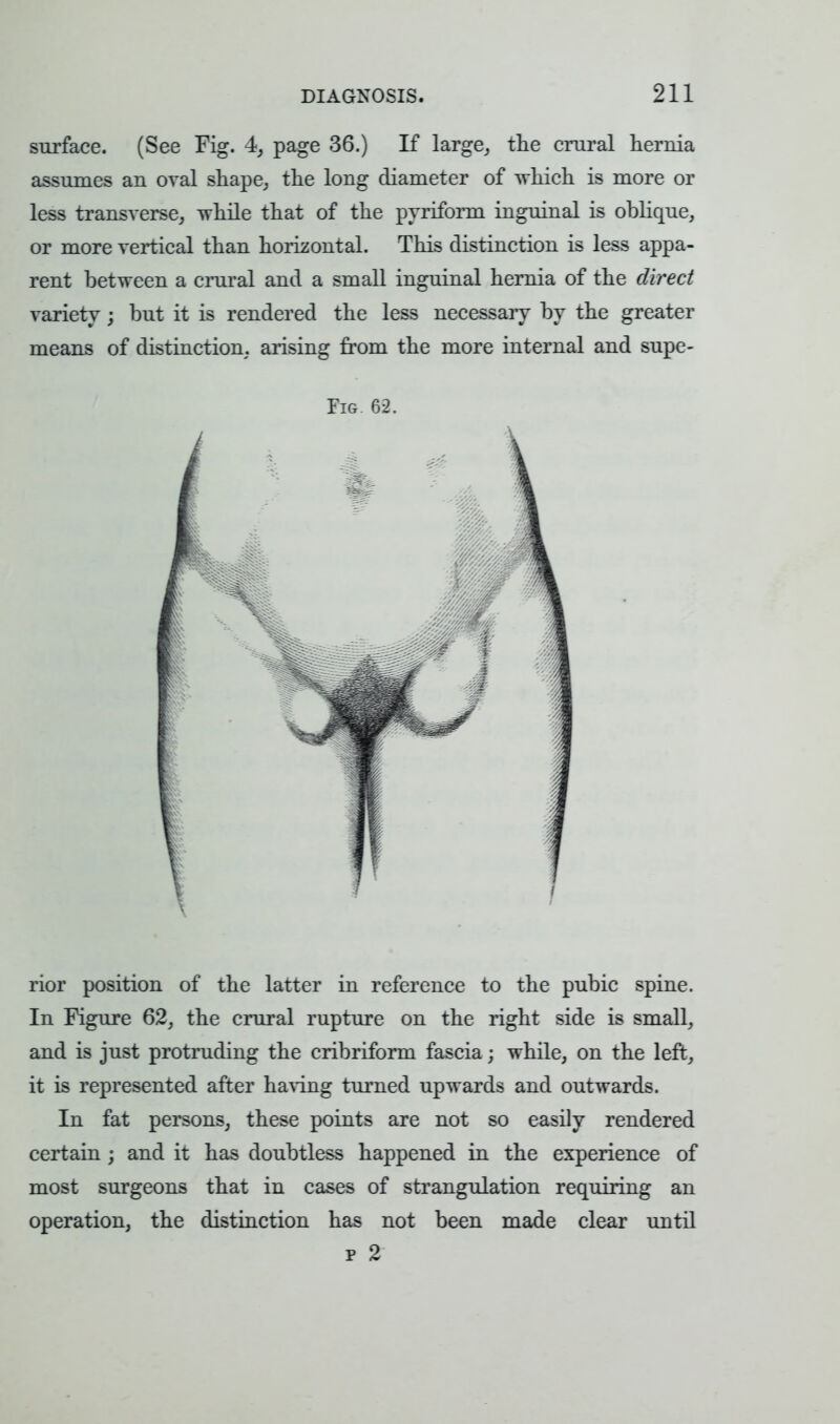 surface. (See Fig. 4, page 36.) If large,, the crural hernia assumes an oval shape, the long diameter of which is more or less transverse, while that of the pyriform inguinal is oblique, or more vertical than horizontal This distinction is less appa- rent between a crural and a small inguinal hernia of the direct variety; but it is rendered the less necessary by the greater means of distinction, arising from the more internal and supe- Fig. 62. rior position of the latter in reference to the pubic spine. In Figure 62, the crural rupture on the right side is small, and is just protruding the cribriform fascia; while, on the left, it is represented after having turned upwards and outwards. In fat persons, these points are not so easily rendered certain ; and it has doubtless happened in the experience of most surgeons that in cases of strangulation requiring an operation, the distinction has not been made clear until r 2