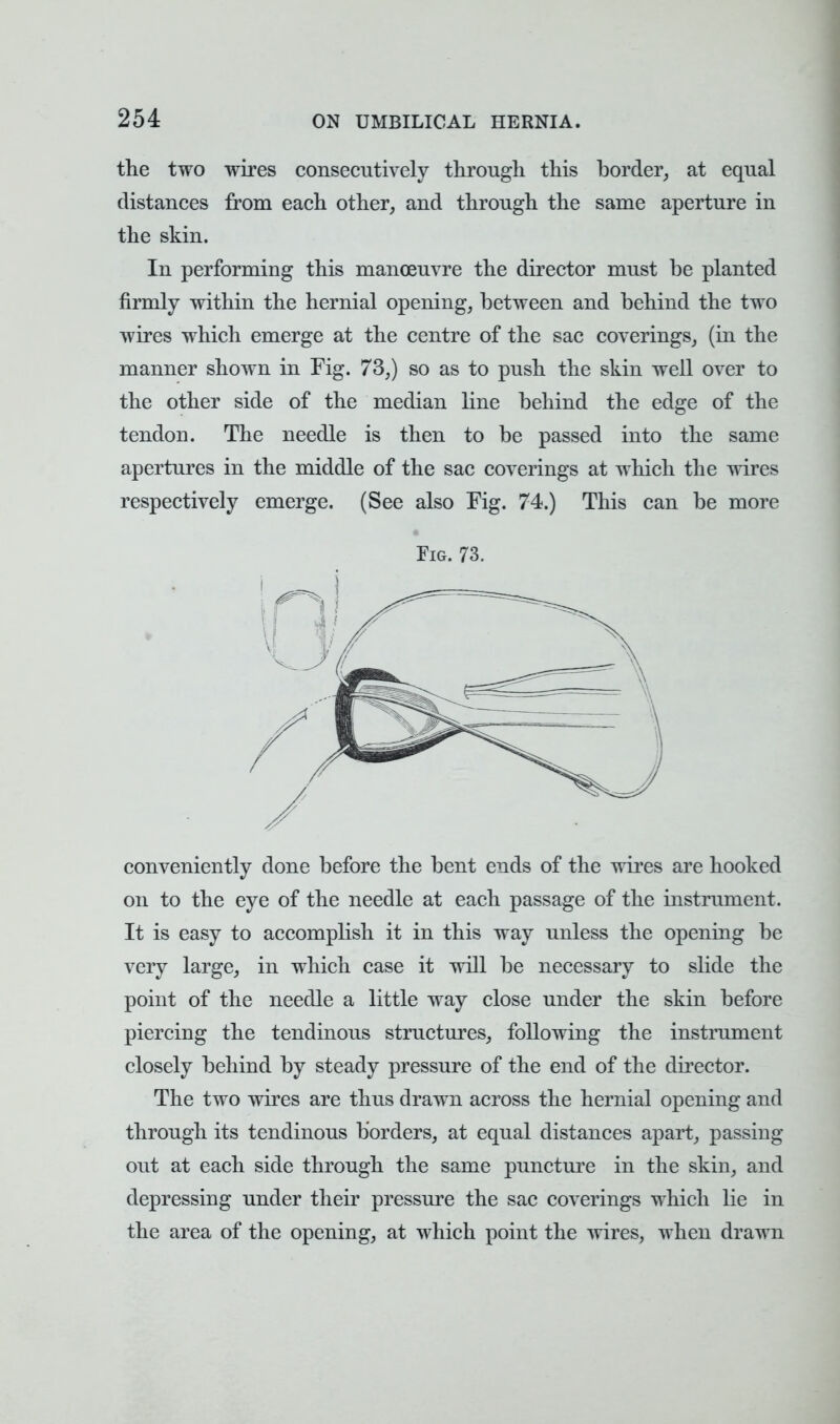 the two wires consecutively through this border, at equal distances from each other, and through the same aperture in the skin. In performing this manoeuvre the director must be planted firmly within the hernial opening, between and behind the two wires which emerge at the centre of the sac coverings, (in the manner shown in Fig. 73,) so as to push the skin well over to the other side of the median line behind the edge of the tendon. The needle is then to be passed into the same apertures in the middle of the sac coverings at which the wires respectively emerge. (See also Fig. 74.) This can be more Fig. 73. conveniently done before the bent ends of the wires are hooked on to the eye of the needle at each passage of the instrument. It is easy to accomplish it in this way unless the opening be very large, in which case it will be necessary to slide the point of the needle a little way close under the skin before piercing the tendinous structures, following the instrument closely behind by steady pressure of the end of the director. The two wires are thus drawn across the hernial opening and through its tendinous borders, at equal distances apart, passing out at each side through the same puncture in the skin, and depressing under their pressure the sac coverings which lie in the area of the opening, at which point the wires, when drawn