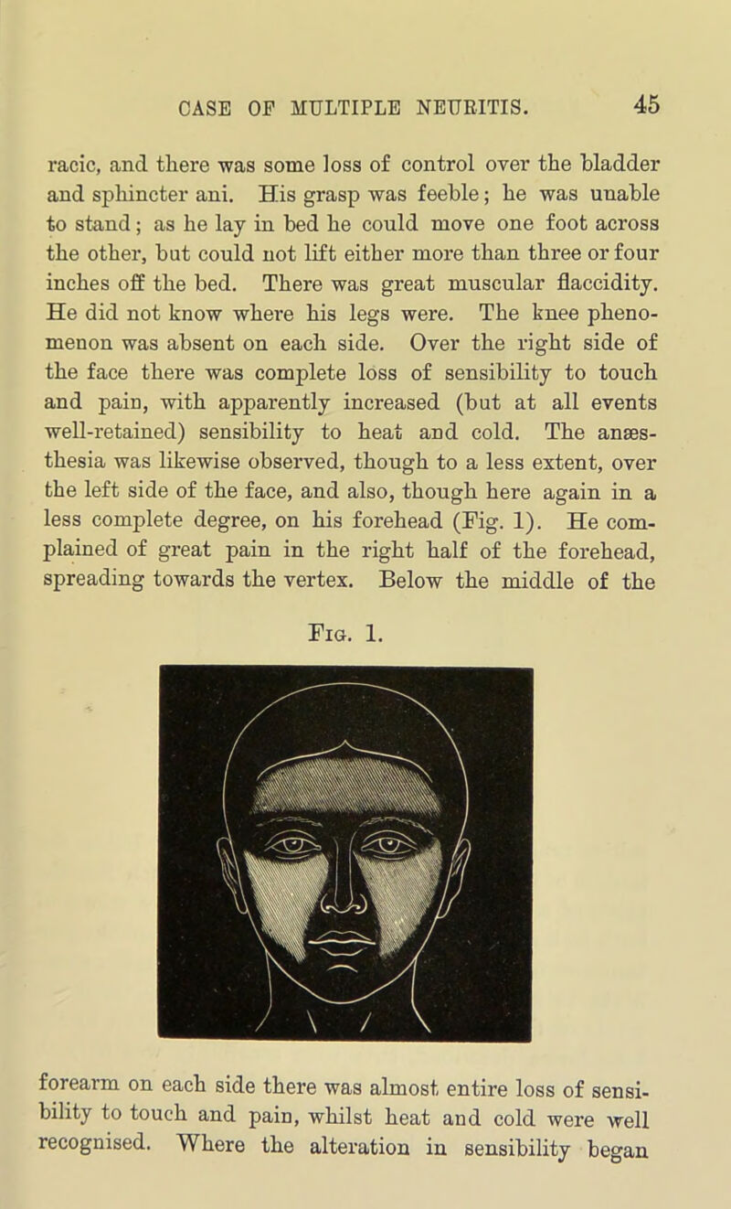 racic, and there was some loss of control over the bladder and sphincter ani. His grasp was feeble; he was unable to stand; as he lay in bed he could move one foot across the other, but could not lift either more than three or four inches off the bed. There was great muscular flaccidity. He did not know where his legs were. The knee pheno- menon was absent on each side. Over the right side of the face there was complete loss of sensibility to touch and pain, with apparently increased (but at all events well-retained) sensibility to heat and cold. The anses- thesia was likewise observed, though to a less extent, over the left side of the face, and also, though here again in a less complete degree, on his forehead (Fig. 1). He com- plained of great pain in the right half of the forehead, spreading towards the vertex. Below the middle of the Fig. 1. forearm on each side there was almost entire loss of sensi- bility to touch and pain, whilst heat and cold were well recognised. Where the alteration in sensibility began