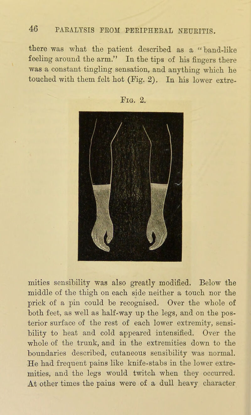 there was what the patient described as a “band-like feeling around tbe arm.” In the tips of his fingers there was a constant tingling sensation, and anything which he touched with them felt hot (Fig. 2). In his lower extre- Fig. 2. mities sensibility was also greatly modified. Below the middle of tbe thigh on each side neither a touch nor the prick of a pin could be recognised. Over the whole of both feet, as well as half-way up the legs, and on the pos- terior surface of the rest of each lower extremity, sensi- bility to heat and cold appeared intensified. Over the whole of the trunk, and in the extremities down to the boundaries described, cutaneous sensibility was normal. He had frequent pains like knife-stabs in the lower extre- mities, and the legs would twitch when they occurred. At other times the pains were of a dull heavy character