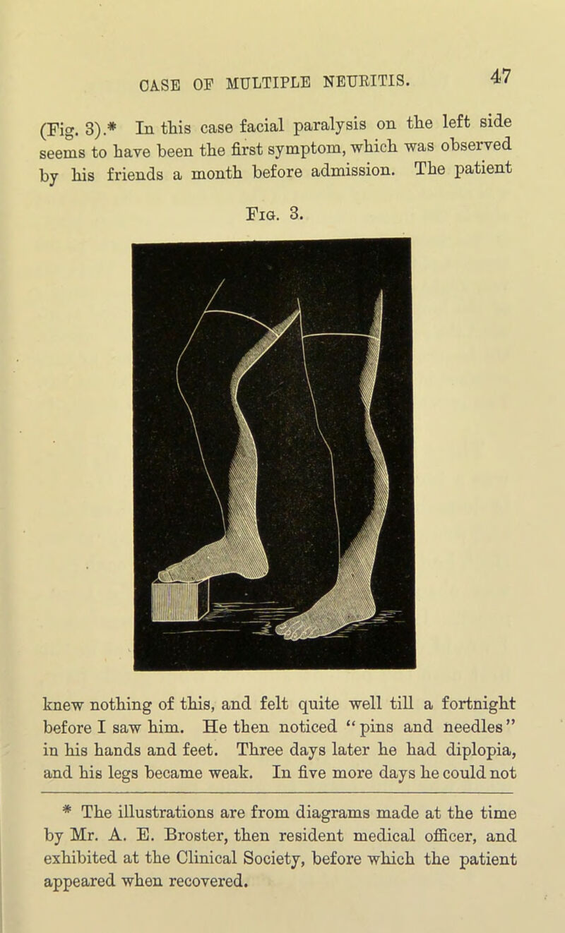 (Fig. 3).* In this case facial paralysis on the left side seems to have been the first symptom, which was observed by his friends a month before admission. The patient Fig. 3. knew nothing of this, and felt quite well till a fortnight before I saw him. He then noticed “ pins and needles ” in his hands and feet. Three days later he had diplopia, and his legs became weak. In five more days he could not * The illustrations are from diagrams made at the time by Mr. A. E. Broster, then resident medical officer, and exhibited at the Clinical Society, before which the patient appeared when recovered.