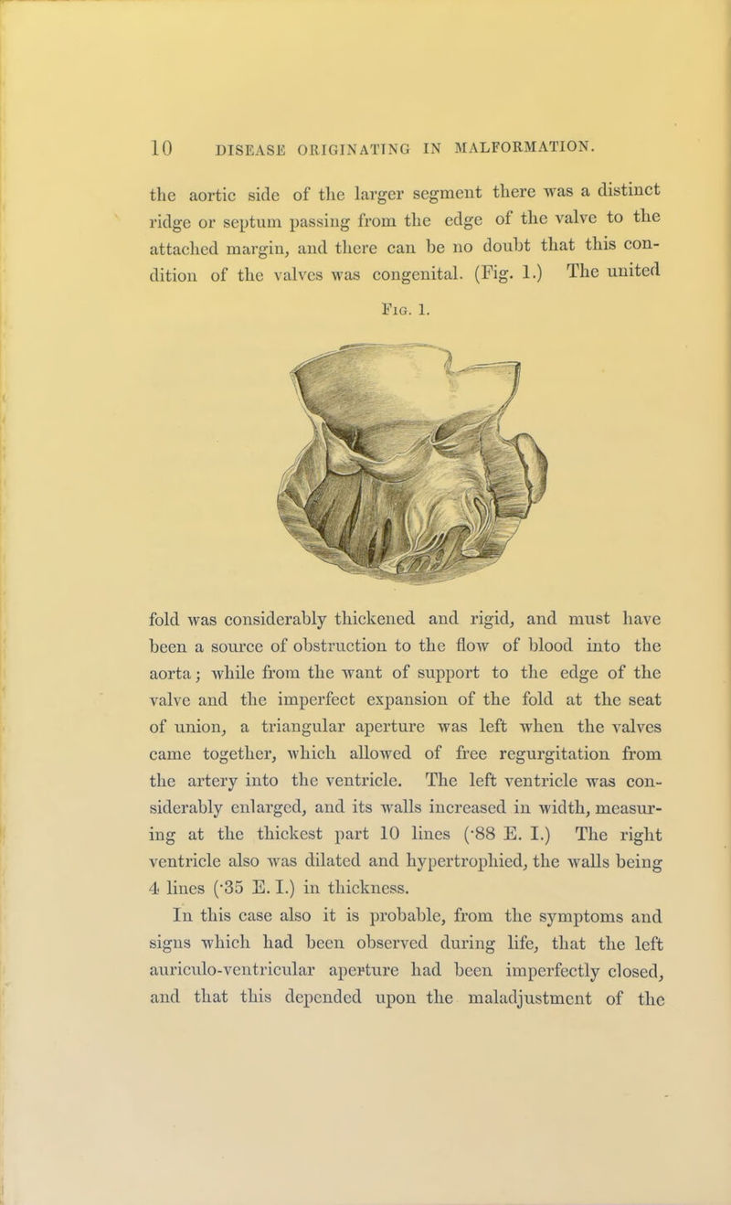the aortic side of the larger segment there was a distinct ridge or septum passing from the edge of the valve to the attached margin, and there can be no douht that this con- dition of the valves was congenital. (Fig. 1.) The united Fig. 1. fold was considerably thickened and rigid, and must have been a source of obstruction to the flow of blood into the aorta; while from the want of support to the edge of the valve and the imperfect expansion of the fold at the seat of union, a triangular aperture was left when the valves came together, which allowed of free regurgitation from the artery into the ventricle. The left ventricle was con- siderably enlarged, and its walls increased in width, measur- ing at the thickest part 10 lines (-88 E. I.) The right ventricle also was dilated and hypertrophied, the walls being 4 lines (35 E. I.) in thickness. In this case also it is probable, from the symptoms and signs which had been observed during life, that the left auriculo-vcntricular aperture had been imperfectly closed, and that this depended upon the maladjustment of the