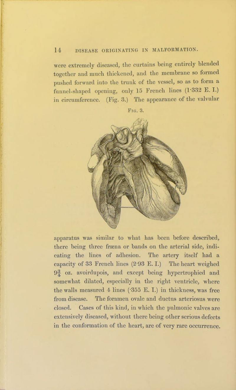 were extremely diseased, the curtains being entirely blended together and much thickened, and the membrane so formed pushed forward into the trunk of the vessel, so as to form a funnel-shaped opening, only 15 French lines (1-332 E. I.) in circumference. (Fig. 3.) The appearance of the valvular Fig. 3. apparatus was similar to what has been before described, there being three frsena or bands on the arterial side, indi- cating the lines of adhesion. The artery itself had a capacity of 33 French lines (2*93 E. I.) The heart weighed 9|; oz. avoirdupois, and except being hypertrophied and somewhat dilated, especially in the right ventricle, where the walls measured 4 lines ('355 E. I.) in thickness, was free from disease. The foramen ovale and ductus arteriosus were closed. Cases of this kind, in which the pulmonic valves are extensively diseased, without there being other serious defects in the conformation of the heart, are of very rare occurrence.