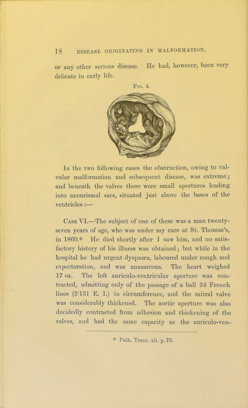 or any other serious disease. He had, however, been very delicate in early life. Fig. 4. In the two following cases the obstruction, owing to val- vular malformation and subsequent disease, was extreme; and beneath the valves there were small apertures leading into aneurismal sacs, situated just aboA'e the bases of the ventricles:— Case VI.—The subject of one of these was a man twenty- seven years of age, who was under my care at St. Thomas's, in I860.* He died shortly after I saw him, and no satis- factory history of his illness was obtained; but while in the hospital he had urgent dyspnoea, laboured under cough and expectoration, and was anasarcous. The heart weighed 17 oz. The left auriculo-ventricular aperture was con- tracted, admitting only of the passage of a ball 24 French lines (2'131 E. I.) in circumference, and the mitral valve was considerably thickened. The aortic aperture was also decidedly contracted from adhesion and thickening of the valves, and had the same capacity as the auriculo-ven-