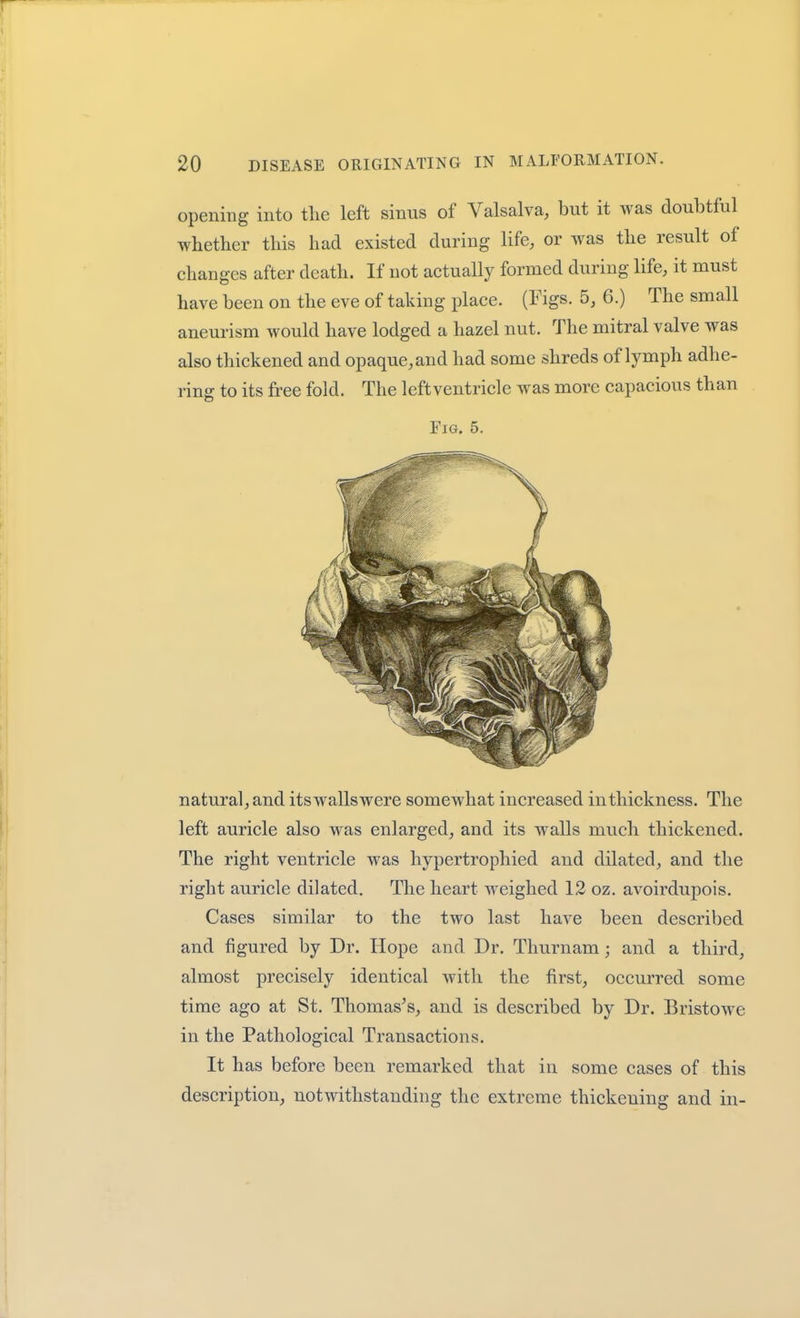 opening into the left sinus of Valsalva, but it was doubtful whether this had existed during life, or was the result of changes after death. If not actually formed during life, it must have been on the eve of taking place. (Figs. 5, 6.) The small aneurism would have lodged a hazel nut. The mitral valve was also thickened and opaque, and had some shreds of lymph adhe- ring to its free fold. The leftventricle was more capacious than natural, and itswallswere somewhat increased in thickness. The left auricle also was enlarged, and its walls much thickened. The right ventricle was hypertrophied and dilated, and the right auricle dilated. The heart weighed 12 oz. avoirdupois. Cases similar to the two last have been described and figured by Dr. Hope and Dr. Thurnam; and a third, almost precisely identical with the first, occurred some time ago at St. Thomases, and is described by Dr. Bristowe in the Pathological Transactions. It has before been remarked that in some cases of this description, notwithstanding the extreme thickening and in- FiG. 5.