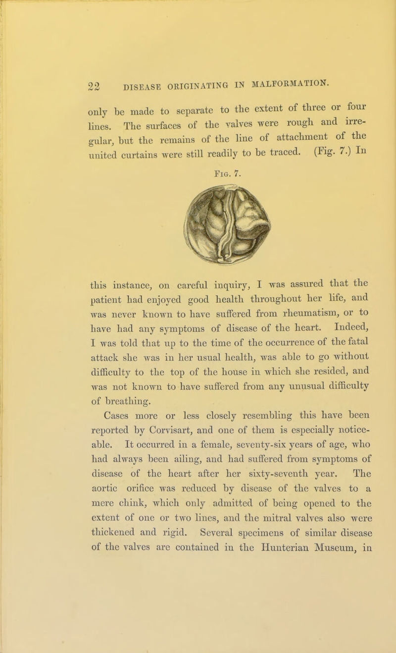 only be made to separate to the extent of three or four lines. The surfaces of the valves were rough and irre- gular, but the remains of the line of attachment of the united curtains were still readily to be traced. (Fig. 7.) In Fig. 7. this instance, on careful inquiry, I was assured that the patient had enjoyed good health throughout her life, and was never known to have suffered from rheumatism, or to have had any symptoms of disease of the heart. Indeed, I was told that up to the time of the occurrence of the fatal attack she was in her usual health, was able to go without difficulty to the top of the house in which she resided, and was not known to have suffered from any unusual difficulty of breathing. Cases more or less closely resembling this have been reported by Corvisart, and one of them is especially notice- able. It occurred in a female, seventy-six years of age, who had always been ailing, and had suffered from symptoms of disease of the heart after her sixty-seventh year. The aortic orifice was reduced by disease of the valves to a mere chink, which only admitted of being opened to the extent of one or two lines, and the mitral valves also were thickened and rigid. Several specimens of similar disease of the valves are contained in the Hunterian Museum, in