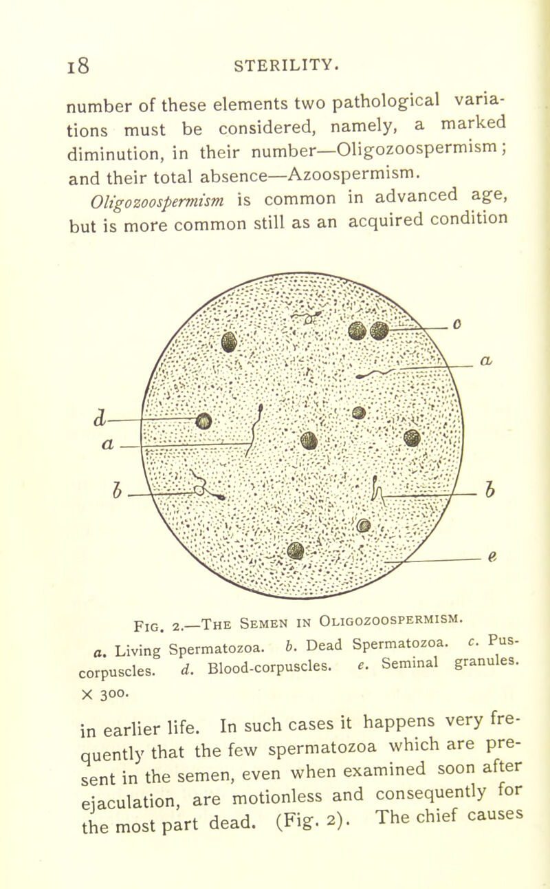 number of these elements two pathological varia- tions must be considered, namely, a marked diminution, in their number—Oligozoospermism; and their total absence—Azoospermism. Oltgozoospermism is common in advanced age, but is more common still as an acquired condition a x'-V!ak''^.'•' -•'■ f•■;■'-•■./.-•/ Fig. 2.—The Semen in Oligozoospermism. a. Living Spermatozoa, b. Dead Spermatozoa, c. Pus- corpuscles. d. Blood-corpuscles. e. Seminal granules. X 300- in earlier life. In such cases it happens very fre- quently that the few spermatozoa which are pre- sent in the semen, even when examined soon after eiaculation, are motionless and consequently for the most part dead. (Fig. 2). The chief causes