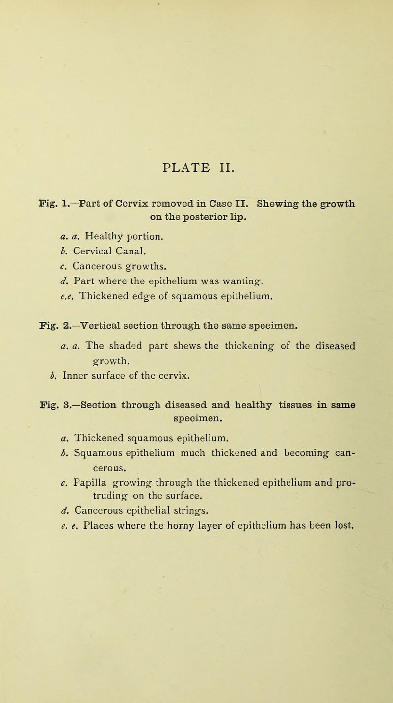 Pig. 1.—Part of Cervix removed in Case II. Shewing the growth on the posterior lip. a. a. Healthy portion. h. Cervical Canal. c. Cancerous growths. d. Part where the epithelium was wanting. e. e. Thickened edge of squamous epithelium. Pig. 2.—Vertical section through the same specimen. a. a. The shaded part shews the thickening of the diseased growth. b. Inner surface of the cervix. Pig. 3.—Section through diseased and healthy tissues in same specimen. a. Thickened squamous epithelium. b. Squamous epithelium much thickened and becoming can- cerous. c. Papilla growing through the thickened epithelium and pro- truding on the surface. d. Cancerous epithelial strings. e. e. Places where the horny layer of epithelium has been lost.