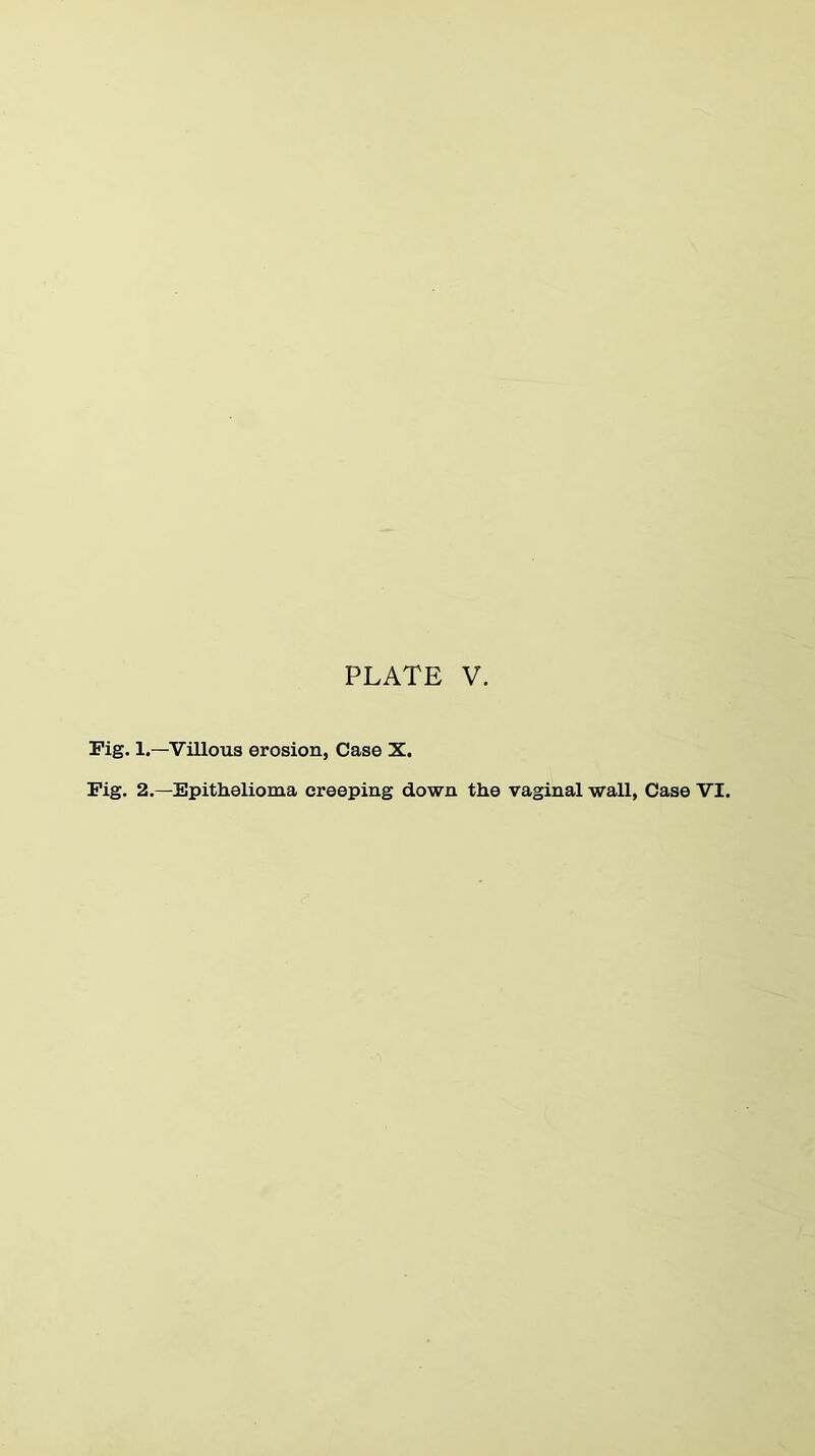 Pig. 1.—Villous erosion, Case X. Pig. 2.—Epithelioma creeping down the vaginal wall, Case VI.