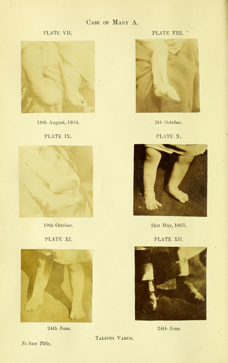 Case of Mary A. PLATE VIL PLATE VIH. 19th August, 18(34. PLATE IX. 19th October. PLATE XL 24th JI 31st May, 1865. PLATE Xn. 24th June. Talipes Varus. To face Title: