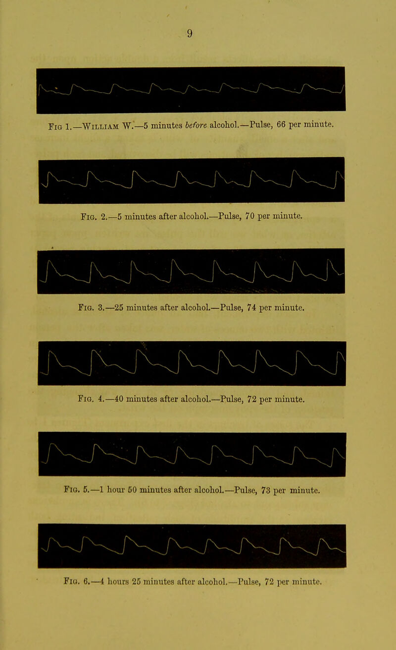 Yig 1.—William W.—5 minutes before alcohol.—Pulse, 66 per minute. Fig. 2.—5 minutes after alcohol.- -Pulse, 70 per minute. 1 ■ Fie. 3.—25 minutes after alcohol.—Pulse, 74 per minute. Fig. 4.—40 minutes after alcohol.—Pulse, 72 per minute. Fig. 5.—1 hour 60 minutes after alcohol.—Pulse, 73 per minute. -J