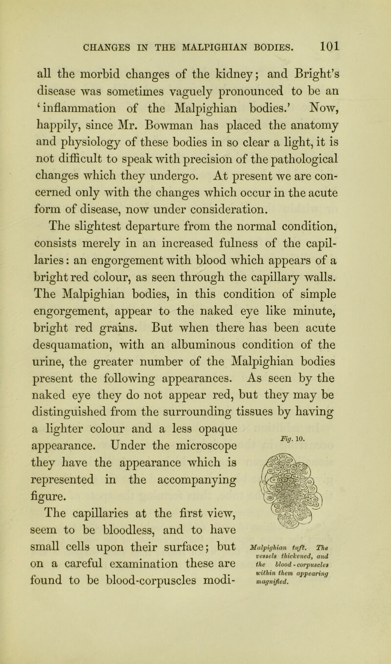 all the morbid changes of the kidney; and Bright’s disease was sometimes vaguely pronounced to be an ‘inflammation of the Malpighian bodies.’ Now, happily, since Mr. Bowman has placed the anatomy and physiology of these bodies in so clear a light, it is not diflScult to speak with precision of the pathological changes which they undergo. At present we are con- cerned only with the changes which occur in the acute form of disease, now under consideration. The slightest departure from the normal condition, consists merely in an increased fulness of the capil- laries : an engorgement with blood which appears of a bright red colour, as seen through the capillary walls. The Malpighian bodies, in this condition of simple engorgement, appear to the naked eye like minute, bright red grains. But when there has been acute desquamation, with an albuminous condition of the urine, the greater number of the Malpighian bodies present the following appearances. As seen by the naked eye they do not appear red, but they may be distinguished from the surrounding tissues by having a lighter colour and a less opaque appearance. Under the microscope Fig.io. they have the appearance which is represented in the accompanying figure. The capillaries at the first view, seem to be bloodless, and to have small cells upon their surface; but Malpighian tuft. The , , vessels thickened, and on a careful examination these are the uood.corpuscles f, 1 iiiT 1 T within them appearing lound to be blood-corpuscles modi- magnified.