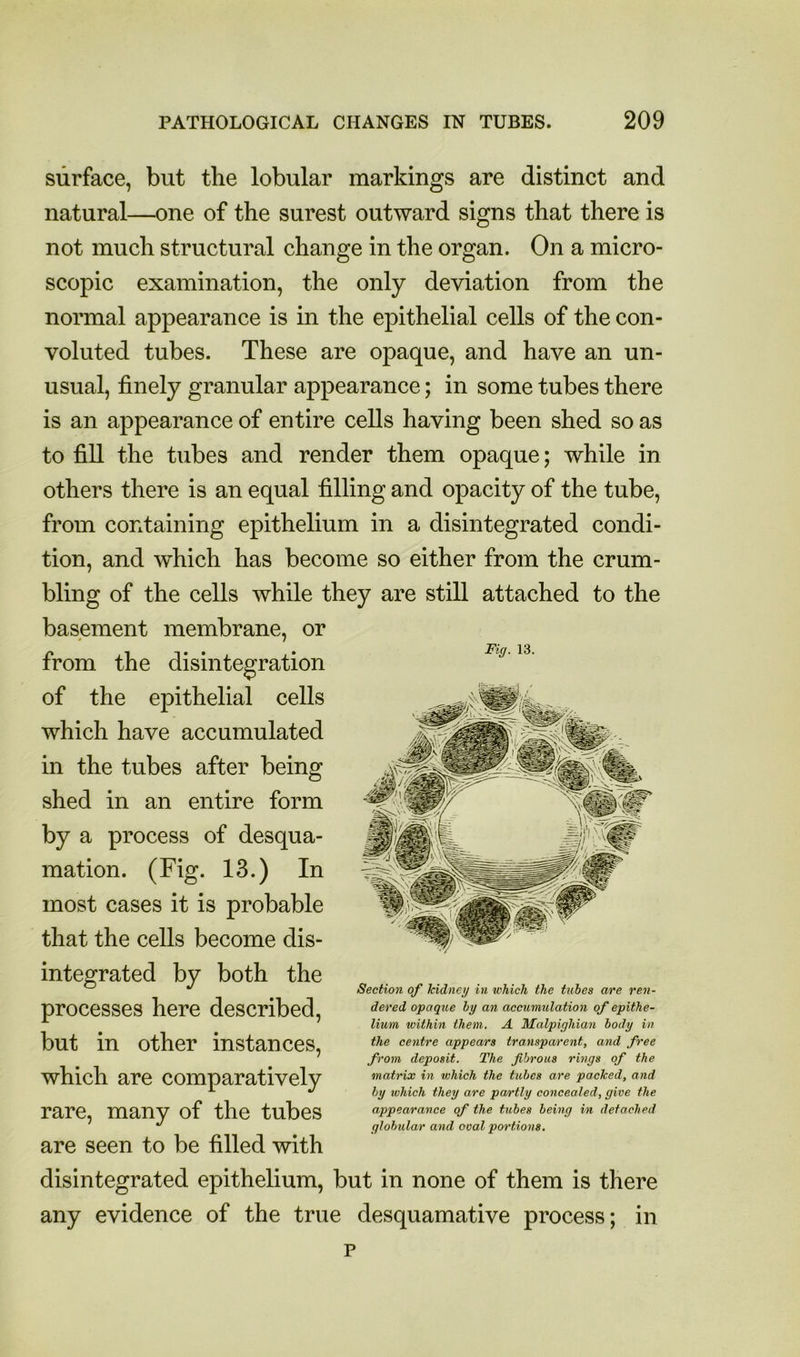 Fig. 13. surface, but the lobular markings are distinct and natural—one of the surest outward signs that there is not much structural change in the organ. On a micro- scopic examination, the only deviation from the normal appearance is in the epithelial cells of the con- voluted tubes. These are opaque, and have an un- usual, finely granular appearance; in some tubes there is an appearance of entire cells having been shed so as to fill the tubes and render them opaque; while in others there is an equal filling and opacity of the tube, from containing epithelium in a disintegrated condi- tion, and which has become so either from the crum- bling of the cells while they are still attached to the basement membrane, or from the disintegration of the epithelial cells which have accumulated in the tubes after being shed in an entire form by a process of desqua- mation. (Fig. 13.) In most cases it is probable that the cells become dis- integrated by both the processes here described, but in other instances, which are comparatively rare, many of the tubes are seen to be filled with disintegrated epithelium, but in none of them is there any evidence of the true desquamative process; in Section of kidneg in which the tubes are ren- dered ofaque hy an accumulation of epithe- lium within them, A Malpighian body in the centre appears transparent, and free from deposit. The fibrous rings of the matrix in which the tubes are packed, and hy which they are partly concealed, give the appearance of the tubes being in detached globular and oval portions. P