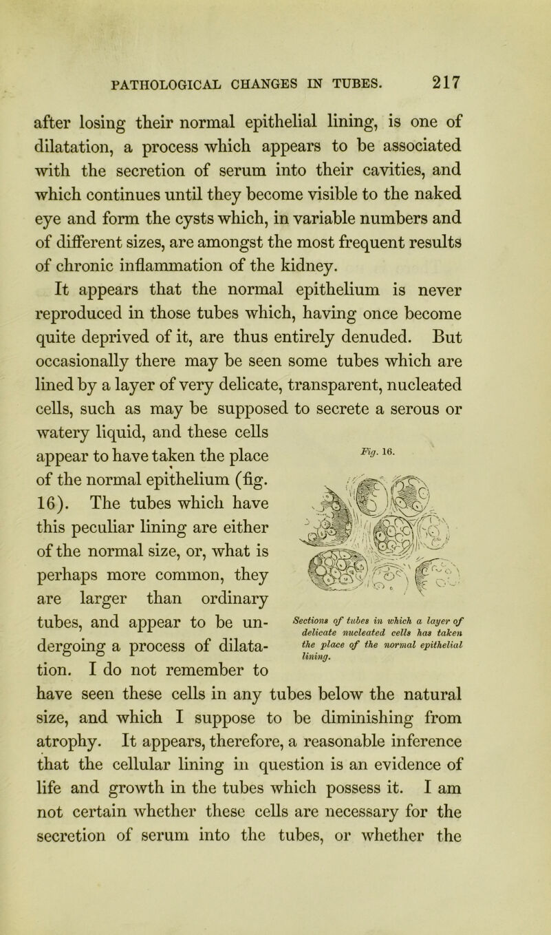 after losing their normal epithelial lining, is one of dilatation, a process which appears to be associated with the secretion of serum into their cavities, and which continues until they become visible to the naked eye and form the cysts which, in variable numbers and of different sizes, are amongst the most frequent results of chronic inflammation of the kidney. It appears that the normal epithelium is never reproduced in those tubes which, having once become quite deprived of it, are thus entirely denuded. But occasionally there may be seen some tubes which are lined by a layer of very delicate, transparent, nucleated cells, such as may be supposed to secrete a serous or watery liquid, and these cells appear to have taken the place of the normal epithelium (fig. 16). The tubes which have this peculiar lining are either of the normal size, or, what is perhaps more common, they are larger than ordinary tubes, and appear to be un- dergoing a process of dilata- tion. I do not remember to have seen these cells in any tubes below the natural size, and which I suppose to be diminishing from atrophy. It appears, therefore, a reasonable inference that the cellular lining in question is an evidence of life and growth in the tubes which possess it. I am not certain whether these cells are necessary for the secretion of serum into the tubes, or whether the Fig. 16. Sections of tubes in which a layer of delicate nucleated cells has taken the place of the normal epithelial lining.