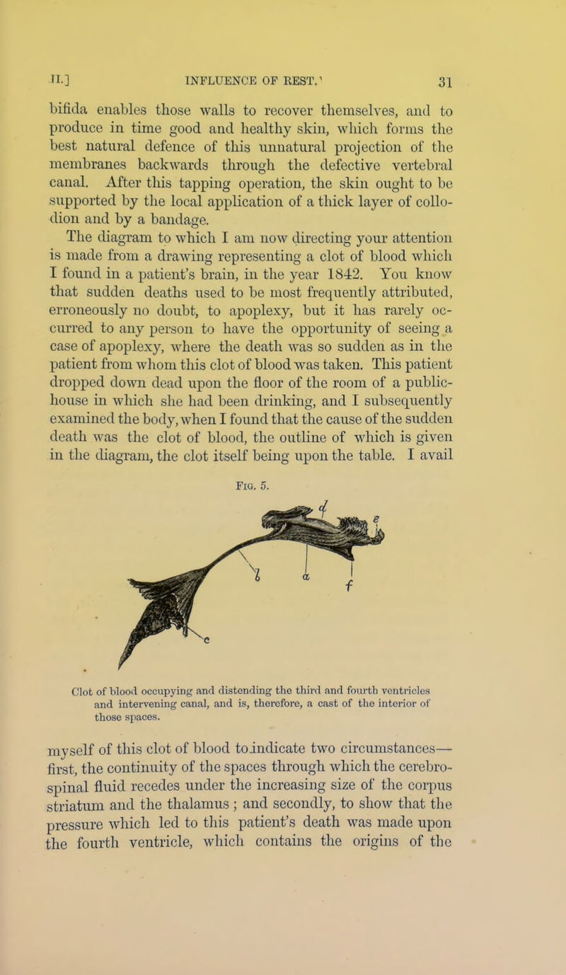 bifida enables those walls to recover themselves, and to produce in time good and healthy skin, which forms the best natural defence of this unnatural projection of the membranes backwards through the defective vertebral canal. After this tapping operation, the skin ought to be supported by the local application of a thick layer of collo- dion and by a bandage. The diagram to which I am now directing your attention is made from a drawing representing a clot of blood which I found in a patient’s brain, in the year 1842. You know that sudden deaths used to be most frequently attributed, erroneously no doubt, to apoplexy, but it has rarely oc- curred to any person to have the opportunity of seeing a case of apoplexy, where the death was so sudden as in the patient from whom this clot of blood was taken. This patient dropped down dead upon the floor of the room of a public- house in which she had been drinking, and I subsequently examined the body, when I found that the cause of the sudden death was the clot of blood, the outline of which is given in the diagram, the clot itself being upon the table. I avail Fig. 5. Clot of blood occupying and distending the third and fourth ventricles and intervening canal, and is, therefore, a cast of the interior of those spaces. myself of this clot of blood toindicate two circumstances— first, the continuity of the spaces through which the cerebro- spinal fluid recedes under the increasing size of the corpus striatum and the thalamus ; and secondly, to show that the pressure which led to this patient’s death was made upon the fourth ventricle, which contains the origins of the