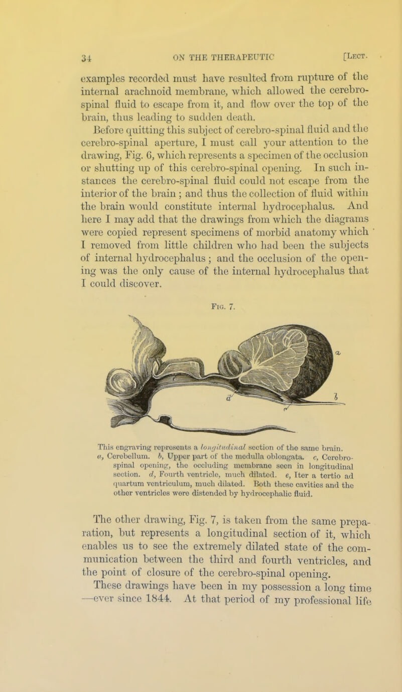 examples recorded must have resulted from rupture of the internal arachnoid membrane, which allowed the cerebro- spinal fluid to escape from it, and flow over the top of the brain, thus leading to sudden death. Before quitting this subject of cerebro-spinal fluid and the cerebro-spinal aperture, I must call your attention to the drawing, Fig. G, which represents a specimen of the occlusion or shutting up of this cerebro-spinal opening. In such in- stances the cerebro-spinal fluid could not escape from the interior of the brain ; and thus the collection of fluid within the brain would constitute internal hydrocephalus. And here I may add that the drawings from which the diagrams were copied represent specimens of morbid anatomy which 1 removed from little children who had been the subjects of internal hydrocephalus ; and the occlusion of the open- ing was the only cause of the internal hydrocephalus that I could discover. Fig. 7. This engraving represents a longitudinal section of the same brain. o, Cerebellum, b, Upper part of the medulla oblongata, c, Cerebro- spinal opening, the occluding membrane seen in longitudinal section, d, Fourth ventricle, much dilated, e, Iter a tertio ad quartum ventriculum, much dilated. Both these cavities and the othor ventriclos were distended by hydrocephalic fluid. The other drawing, Fig. 7, is taken from the same prepa- ration, but represents a longitudinal section of it, which enables us to see the extremely dilated state of the com- munication between the third and fourth ventricles, and the point of closure of the cerebro-spinal opening. These drawings have- been in my possession a long time —ever since 1844. At that period of my professional life