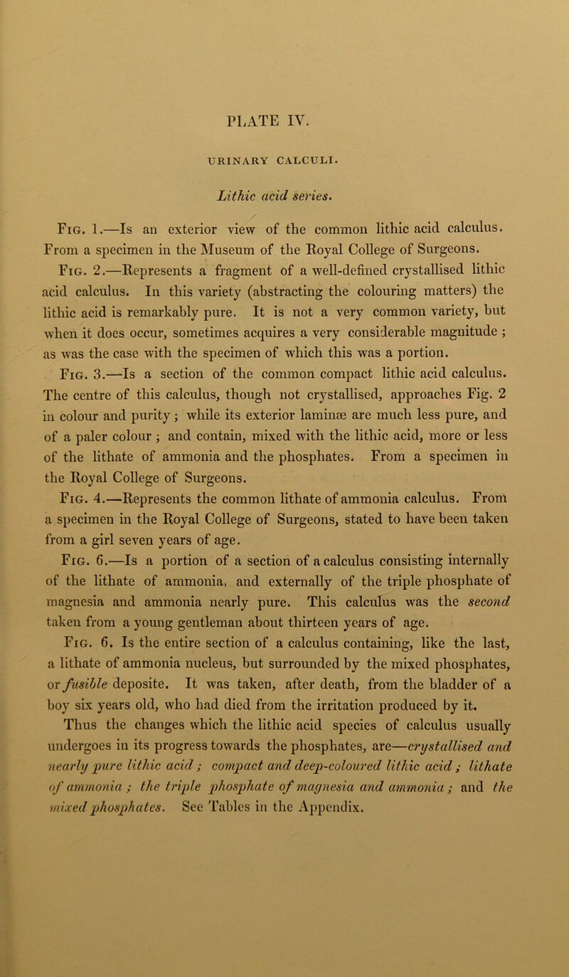 URINARY CALCULI. Lithic acid series. Fig. 1.—Is an exterior view of the common lithic acid calculus. From a specimen in the Museum of the Royal College of Surgeons. Fig. 2.—Represents a fragment of a well-defined crystallised lithic acid calculus. In this variety (abstracting the colouring matters) the lithic acid is remarkably pure. It is not a very common variety, hut when it does occur, sometimes acquires a very considerable magnitude ; as was the case with the specimen of which this was a portion. Fig. 3.—Is a section of the common compact lithic acid calculus. The centre of this calculus, though not crystallised, approaches Fig. 2 in colour and purity; while its exterior laminse are much less pure, and of a paler colour ; and contain, mixed with the lithic acid, more or less of the lithate of ammonia and the phosphates. From a specimen in the Royal College of Surgeons. Fig. 4.—Represents the common lithate of ammonia calculus. From a specimen in the Royal College of Surgeons, stated to have been taken from a girl seven years of age. Fig. 6.—Is a portion of a section of a calculus consisting internally of the lithate of ammonia, and externally of the triple phosphate of magnesia and ammonia nearly pure. This calculus was the second taken from a young gentleman about thirteen years of age. Fig. 6. Is the entire section of a calculus containing, like the last, a lithate of ammonia nucleus, but surrounded by the mixed phosphates, or fusible deposite. It was taken, after death, from the bladder of a boy six years old, who had died from the irritation produced by it. Thus the changes which the lithic acid species of calculus usually undergoes in its progress towards the phosphates, are—crystallised and nearly pure lithic acid; compact and deep-coloured lithic acid ; lithate of ammonia ; the triple phosphate of magnesia and ammonia ; and the mixed phosphates. See Tables in the Appendix.