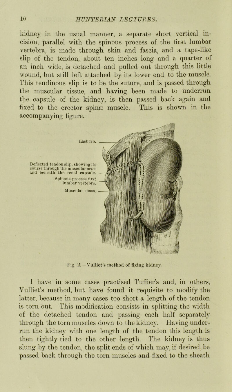 kidney in the usual manner, a separate short vertical in- cision, parallel with the spinous process of the first lumbar vertebra, is made through skin and fascia, and a tape-like slip of the tendon, about ten inches long and a quarter of an inch wide, is detached and pulled out through this little wound, but still left attached by its lower end to the muscle. This tendinous slip is to be the suture, and is passed through the muscular tissue, and having been made to underrun tlie capsule of the kidney, is then passed back again and fixed to the erector spin?e muscle. This is shown in the accompanying figure. Last rib. Deflected tendon slip, showing its course througli the muscular mass and beneath the renal capsule. Spinous process first lumbar vertebra. Muscular mass. Fig. 2.—Vulliet’s method of fixing kidney. I have in some cases practised Tuffier’s and, in others, Yulliet’s method, but have found it requisite to modify the latter, because in many cases too short a length of the tendon is torn out. This modification consists in splitting the Avidth of the detached tendon and passing each half separately through the torn muscles doAvn to the kidne}*. Having under- run the kidney Avith one length of the tendon this length is then tightly tied to the other length. The kidney is thus slung by the tendon, the split ends of Avhich may, if desired, bo passed back through the torn muscles and fixed to the sheath