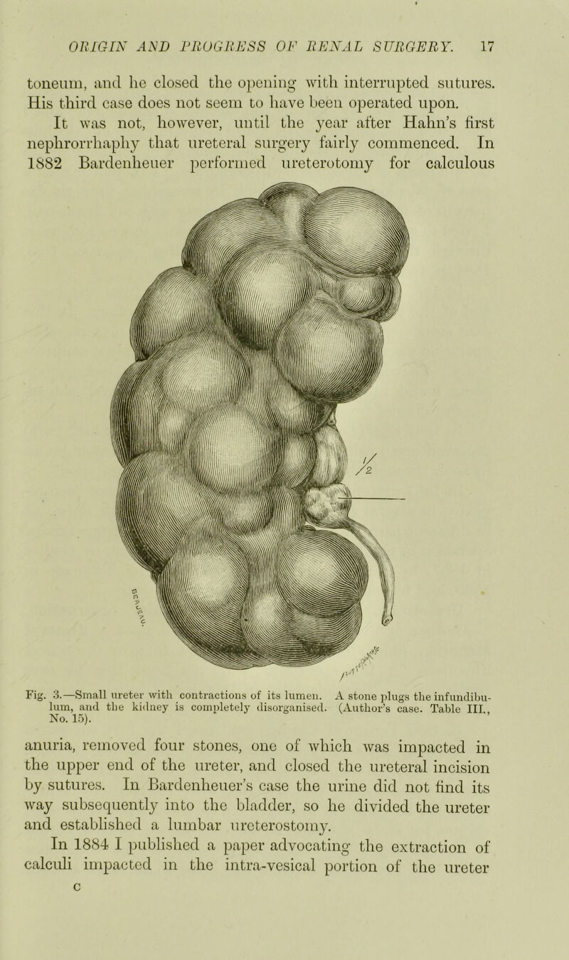 toneum, and he closed the opening with interrupted sutures. His third case does not seem to have been operated upon. It was not, hoAvever, until the }^ear after Hahn’s first nephrorrhaphy that ureteral surgery fairly commenced. In 1882 Bardenheuer performed ureterotomy for calculous Fig. 3.—Small ureter with contractions of its lumen. A stone ]»lugs the infundibu- lum, and the kidney is completely disorganised. (xUithor’s case. Table III.. No. 15). anuria, removed four stones, one of which was impacted in the upper end of the ureter, and closed the ureteral incision by sutures. In Bardenheuer’s case the urine did not find its way subsequently into the bladder, so he divided the ureter and established a lumbar ureterostomy. In 1884 I published a paper advocating the extraction of calculi impacted in the intra-vesical portion of the ureter c