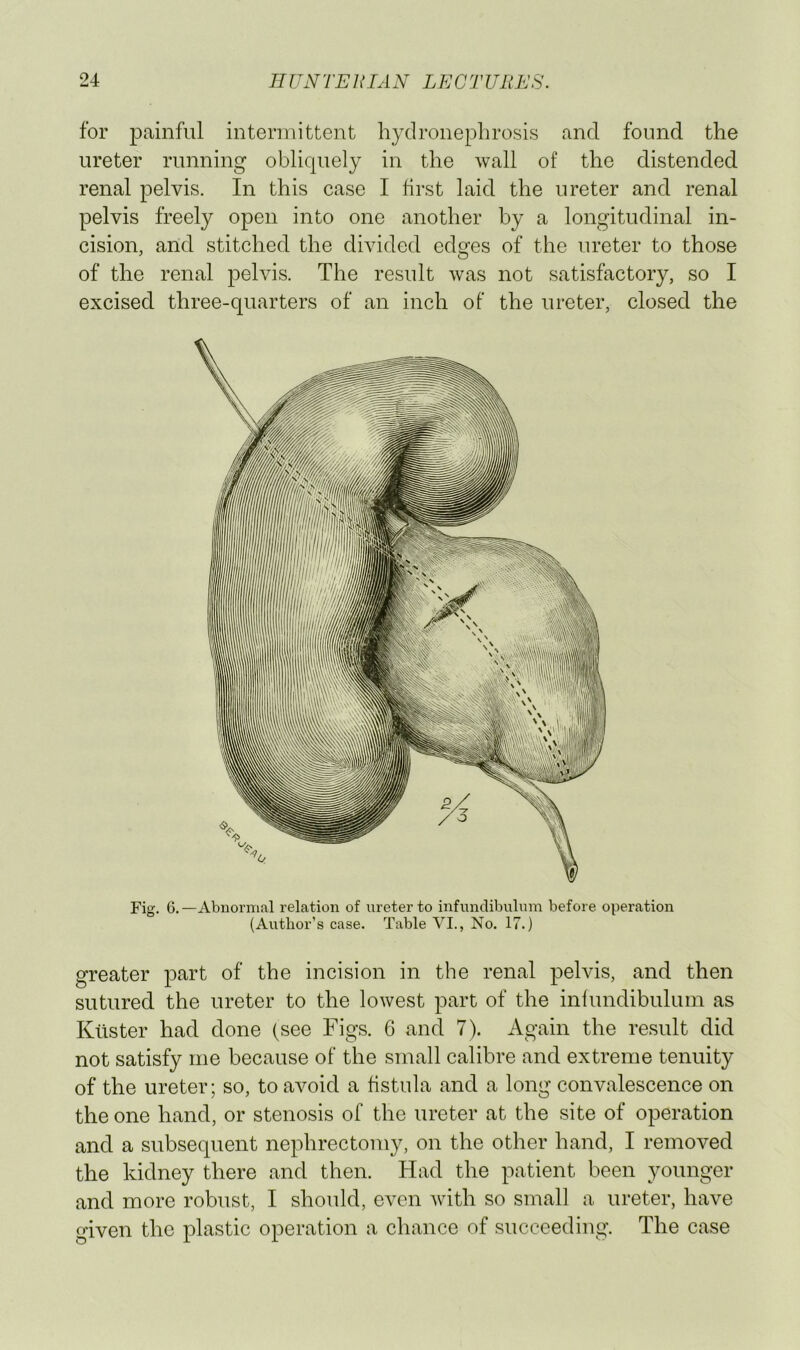 for painful intermittent hydronephrosis and found the ureter running obliquely in the wall of the distended renal pelvis. In this case I first laid the ureter and renal pelvis freely open into one another by a longitudinal in- cision, and stitched the divided edges of the ureter to those of the renal pelvis. The result was not satisfactory, so I excised three-quarters of an inch of the ureter, closed the W Fig. 6.—Abnormal relation of ureter to infundibulum before operation (Author’s case. Table VI., No. 17.) greater part of the incision in the renal pelvis, and then sutured the ureter to the lowest part of the infundibulum as Kiister had done (see Figs. 6 and 7). Again the result did not satisfy me because of the small calibre and extreme tenuity of the ureter; so, to avoid a fistula and a long convalescence on the one hand, or stenosis of the ureter at the site of operation and a subsequent nephrectomy, on the other hand, I removed the kidney there and then. Had the patient been younger and more robust, I should, even with so small a ureter, have given the plastic operation a chance of succeeding. The case