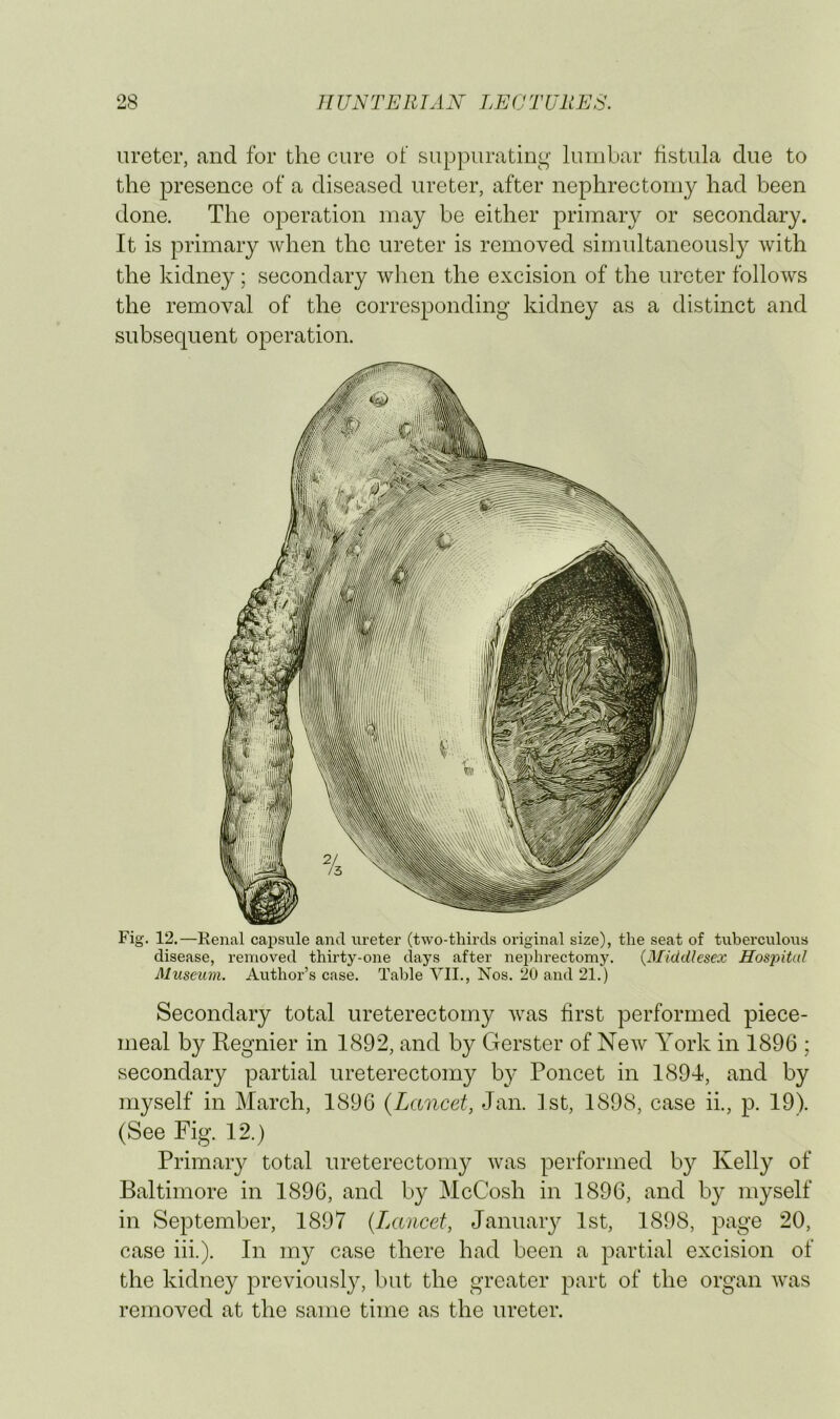 ureter, and for the cure of supj^uratiuL;’ lumbar fistula due to the presence of a diseased ureter, after nephrectomy had been done. The operation may be either primary or secondary. It is primary when the ureter is removed simultaneously with the kidney; secondary when the excision of the ureter follows the removal of the corresponding kidney as a distinct and subsequent operation. Fig. 12.—Renal capsule and ureter (two-thirds original size), the seat of tuberculous disease, removed thirty-one days after nephrectomy. {Middlesex Hospital Museum. Author’s case. Table VII., Nos. 20 and 21.) Secondary total ureterectomy was first performed piece- meal by Regnier in 1892, and by Gerster of New York in 1896 ; secondary partial ureterectomy by Poncet in 1894, and by myself in March, 1896 {Lancet, Jan. 1st, 1898, case ii., p. 19). (See Fig. 12.) Primary total ureterectomy was performed by Kelly of Baltimore in 1896, and by McCosh in 1896, and by myself in September, 1897 {Lancet, Januaiy 1st, 1898, page 20, case iii.). In my case there had been a partial excision of the kidney previously, but the greater part of the organ was removed at the same time as the ureter.