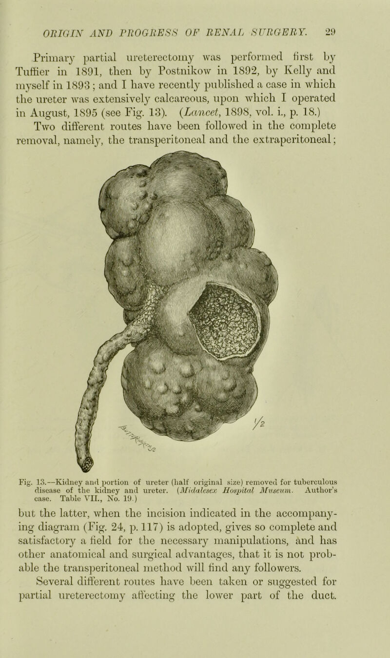 Primary partial ureterectomy was performed first by Tiiffier in 1891, tlien by Postnikow in 1892, by Kelly and myself in 1893 ; and I have recently published a case in which the ureter was extensivel}^ calcareous, upon which I operated in August, 1895 (see Fig. 13). {Lancet, 1898, vol. i., p. 18.) Two different routes have been followed in the complete removal, namely, the transperitoneal and the extraperitoneal; Fig. 13.—Kidney and portion of ureter (half original size) removed for tuberculous disease of the kidney and ureter. [Midalesex Hosiiital ]\fiiseum. Author’s case. Table VII., No. 10 ) but the latter, when the incision indicated in the accompany- ing diagram (Fig. 24, p. 117) is adopted, gives so complete and satisfactory a field for the necessary manipulations, and has other anatomical and surgical advantages, that it is not prob- able the transjieritoneal method will find any followers. Several different routes have been taken or suggested for partial ureterectomy affecting the lower part of the duct.