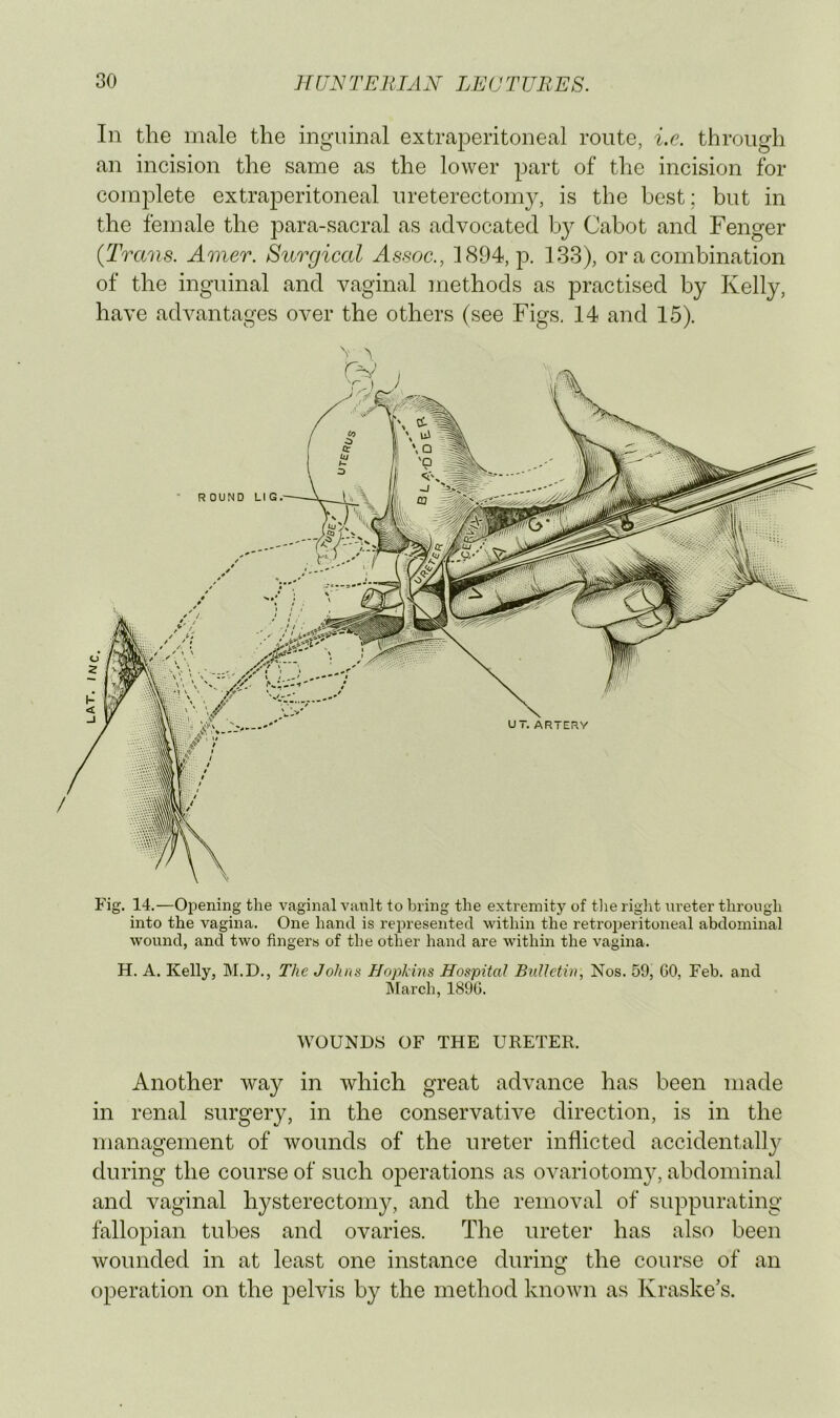 LAT. /fjc In the male the inguinal extraperitoneal route, i.e. through an incision the same as the lower part of the incision for complete extraperitoneal ureterectomy, is the best ; but in the female the para-sacral as advocated by Cabot and Fenger {Trans. Amer. Surgical Assoc., 1894, 133), or a combination of the inguinal and vaginal methods as practised by Kelly, have advantages over the others (see Figs. 14 and 15). Fig. 14.—Opening the vaginal vault to bring the extremity of tlie riglit lu’eter through into the vagina. One hand is represented within the retroperitoneal abdominal wound, and two fingers of the other hand are within the vagina. H. A. Kelly, M.D., The Johns HopMns Hospital Bulletin, Nos. 59, GO, Feb. and IMarch, 189G. WOUNDS OF THE URETER. Another way in which great advance has been made in renal surgery, in the conservative direction, is in the management of wounds of the ureter inflicted accidental!}^ during the course of such operations as ovariotomy, abdominal and vaginal hysterectomy, and the removal of suppurating fallopian tubes and ovaries. The ureter has also been wounded in at least one instance during the course of an operation on the pelvis by the method known as Kraske’s.