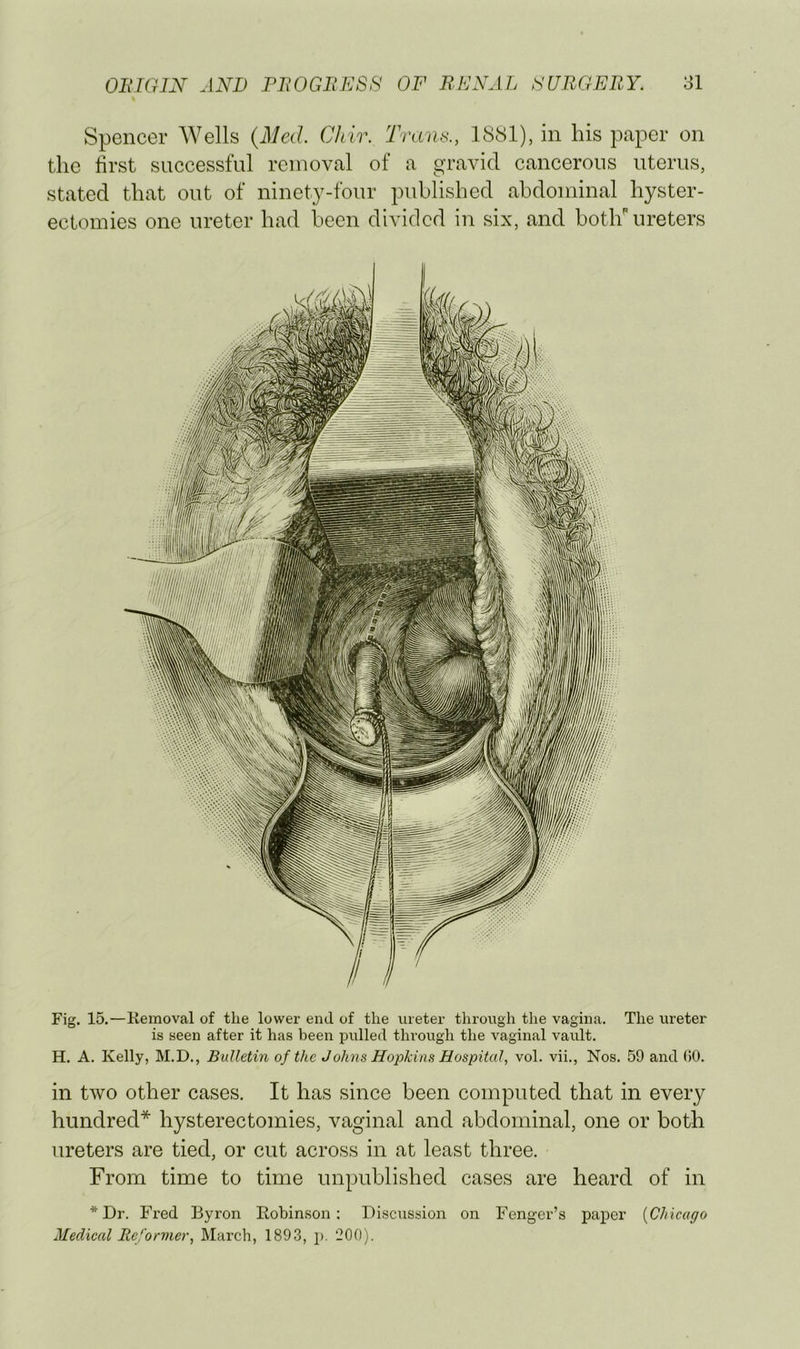 Spencer Wells {Aled. Chir. Trans., 1881), in his paper on the first successful removal of a gravid cancerous uterus, stated that out of ninety-four published abdominal hyster- ectomies one ureter had been divided in six, and botlr ureters Fig. 15.—Removal of the lower end of the ureter through the vagina. The ureter is seen after it has been pulled through the vaginal vault. H. A. Kelly, M.D., Bulletin of tlte Johns Hopkins Hospital, vol. vii., Nos. 59 and (50. in two other cases. It has since been computed that in every hundred* hysterectomies, vaginal and abdominal, one or both ureters are tied, or cut across in at least three. From time to time unpublished cases are heard of in * Dr. Fred Byron Robin.son; Discussion on Fenger’s paper [Chicago Medical Reformer, March, 1893, j). 200).