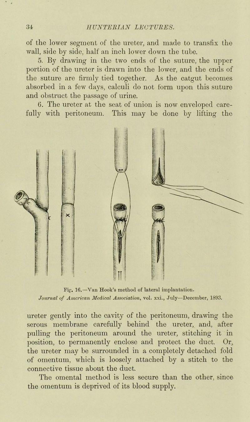 of the lower segment of the ureter, and made to transfix the Avail, side by side, half an inch lower down the tube. 5. By draAving in the tAvo ends of the suture, the upper portion of the ureter is draAvn into the loAver, and the ends of the suture are firmly tied together. As the catgut becomes absorbed in a feAv days, calculi do not form upon this suture and obstruct the passage of urine. 6. The ureter at the seat of union is noAv enveloped care- fully Avith peritoneum. This may be done by lifting the Fig-. 16.—Vail Hook’s method of lateral implantation. Journal of American Medical Association, vol. xxi., July—December, 1S93. ureter gently into the cavity of the peritoneum, draAving the serous membrane carefully behind the ureter, and, after pulling the peritoneum around the ureter, stitching it in position, to permanently enclose and protect the duct. Or, the ureter may be surrounded in a completely detached fold of omentum, Avhich is loosely attached by a stitch to the connective tissue about the duct. The omental method is less secure than the other, since the omentum is deprived of its blood supply.