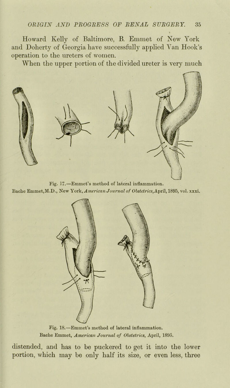 Howard Kelly of Baltiiriore, B. Emmet of New York and Doherty of Georgia have successfully applied Van Hook’s operation to the ureters of women. When the upper portion of the divided ureter is very much Fig. 17.—Emmet’s method of lateral inflammation. BacLe Emmet,M.D., New York., American Journal of Obstetrics, 1895, vol. xxxi. Fig. 18.—Emmet’s method of lateral inflammation. Bache Emmet, American Journal of Obstetrics, April, 1895. distended, and has to be puckered to get it into the lower portion, which may be only half its size, or even less, three