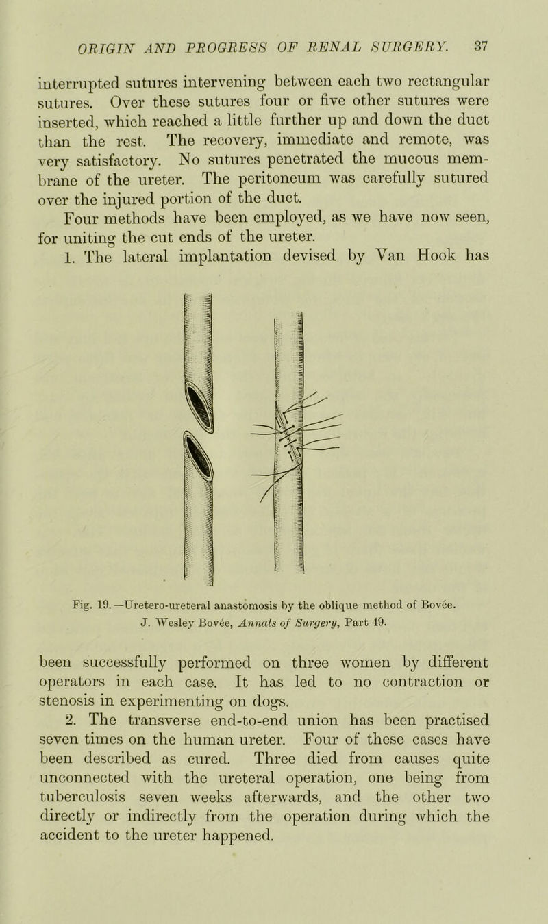 interrupted sutures intervening between each tAvo rectangular sutures. Over these sutures four or five other sutures were inserted, Avhich reached a little further up and down the duct than the rest. The recovery, immediate and remote, Avas very satisfactory. No sutures penetrated the mucous mem- brane of the ureter. The peritoneum Avas carefully sutured over the injured portion of the duct. Four methods have been employed, as we have noAv seen, for uniting the cut ends of the ureter. 1. The lateral implantation devised by Van Hook has Fig. 19.—Uretero-ureteral anastomosis by the oblique method of Bovee. J. AVesley Bovee, Annals of Surgery, Part 49. been successfully performed on three Avomen by different operators in each case. It has led to no contraction or stenosis in experimenting on dogs. 2. The transverse end-to-end union has been practised seven times on the human ureter. Four of these cases have been described as cured. Three died from causes quite unconnected Avith the ureteral operation, one being from tuberculosis seven Aveeks afterAvards, and the other tAvo directly or indirectly from the operation during Avhich the accident to the ureter happened.
