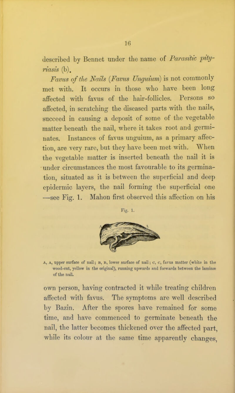 If) described by Bennet under the name of Parasitic pity- riasis (b). Fames of the Nails (.Favus Unguium) is not commonly met with. It occurs in those who have been long affected with favus of the hair-follicles. Persons so affected, in scratching the diseased parts with the nails, succeed in causing a deposit of some of the vegetable matter beneath the nail, where it takes root and germi- nates. Instances of favus unguium, as a primary affec- tion, are very rare, but they have been met with. When the vegetable matter is inserted beneath the nail it is under circumstances the most favourable to its germina- tion, situated as it is between the superficial and deep epidermic layers, the nail forming the superficial one —see Fig. 1. Mahon first observed this affection on his Fig. 1. A, a, upper surface of nail; b, b, lower surface of nail; c, c, favus matter (white in the wood-cut, yellow in the original), running upwards and forwards between the lamina? of the nail. own person, having contracted it while treating children affected with favus. The symptoms are well described by Bazin. After the spores have remained for some time, and have commenced to germinate beneath the nail, the latter becomes thickened over the affected part, while its colour at the same time apparently changes,