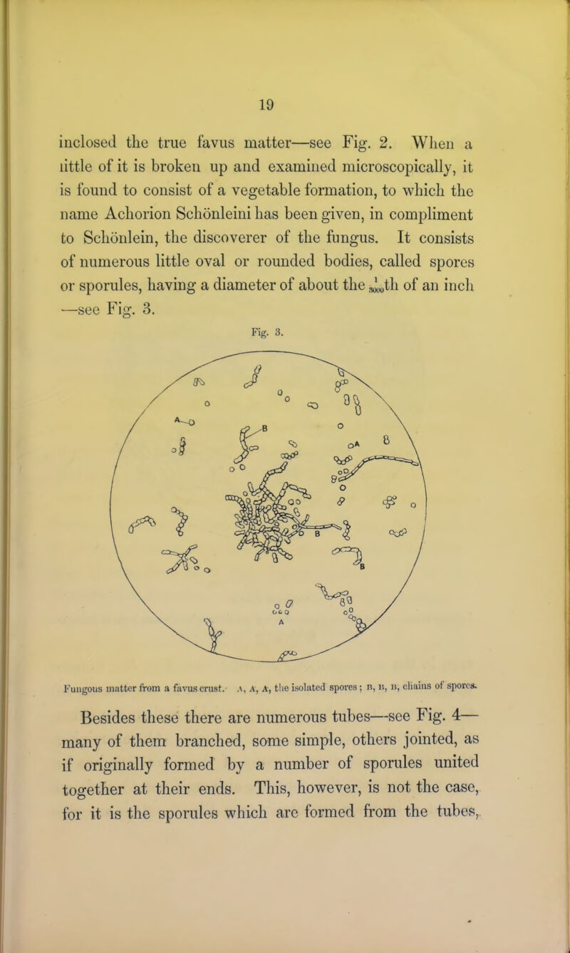 inclosed the true favus matter—see Fig. 2. When a little of it is broken up and examined microscopically, it is found to consist of a vegetable formation, to which the name Achorion Schonleini has been given, in compliment to Schbnlein, the discoverer of the fungus. It consists of numerous little oval or rounded bodies, called spores or sporules, having a diameter of about the J^tli of an inch —see Fig. 3. Fig. 3. Fungous matter from a favus crust.- A, A, t!ie isolated spores; n, it, b, chains of spores. Besides these there are numerous tubes—see Fig. 4— many of them branched, some simple, others jointed, as if originally formed by a number of sporules united together at their ends. This, however, is not the case, for it is the sporules which arc formed from the tubes,