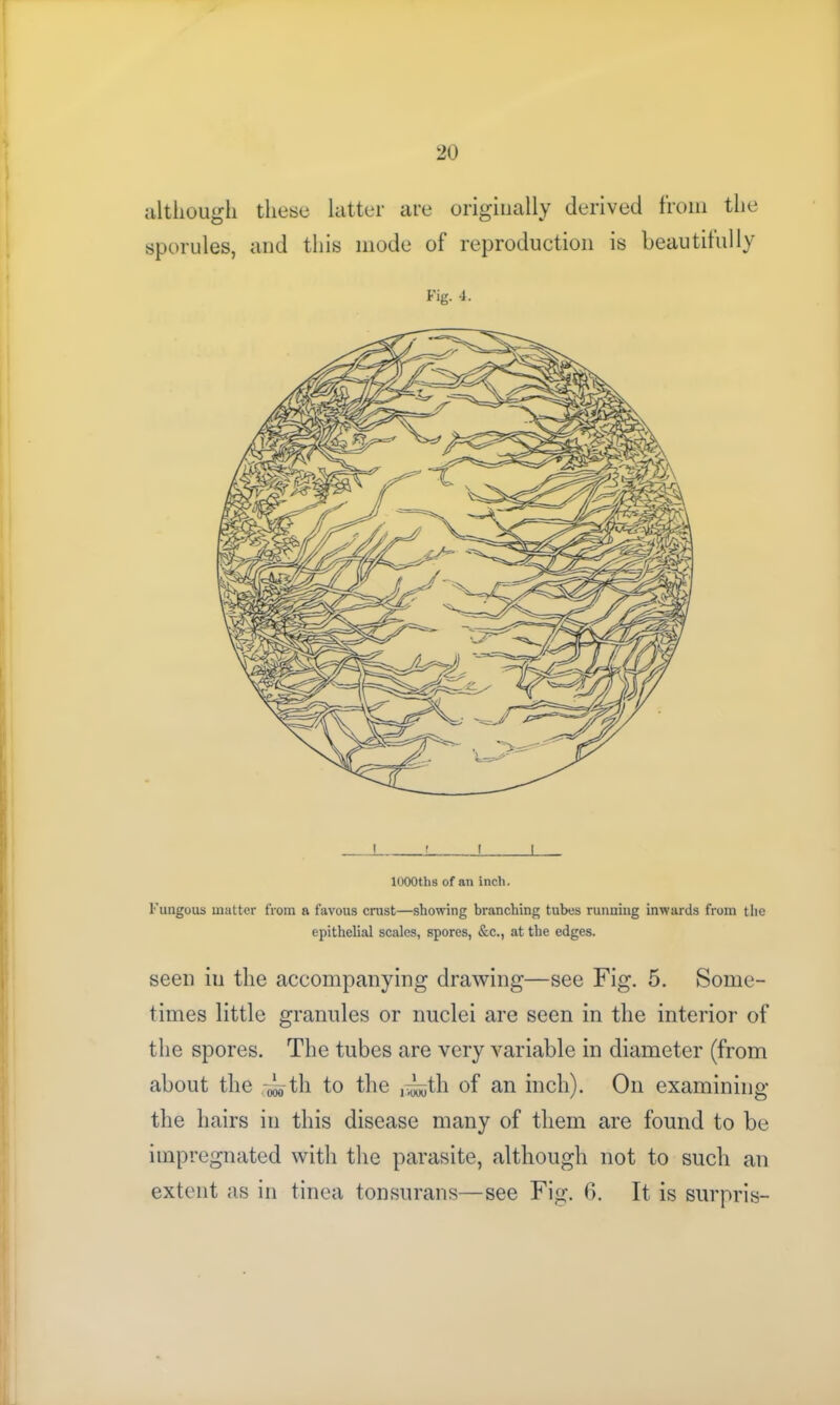 although these latter are originally derived from the sporules, and this mode of reproduction is beautifully Fig. 4. ! > I I lOOOths of an inch. Fungous matter from a favous crust—showing branching tubes running inwards from the epithelial scales, spores, &c., at the edges. seen in the accompanying drawing—see Fig. 5. Some- times little granules or nuclei are seen in the interior of the spores. The tubes are very variable in diameter (from about the ith to the ,^tli of an inch). On examining the hairs in this disease many of them are found to be impregnated with the parasite, although not to such an extent as in tinea tonsurans—see Fig. 6. It is surpris-