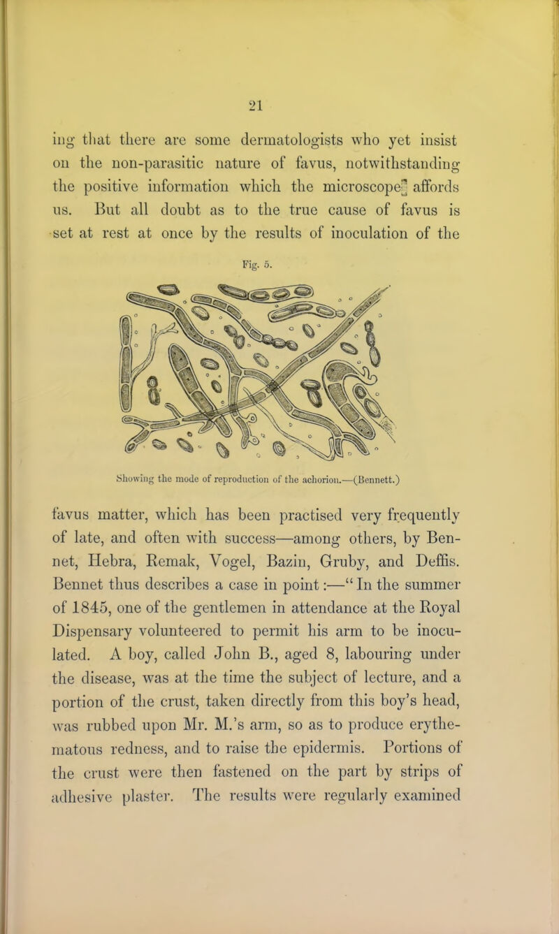 mg that there are some dermatologists who yet insist on the non-parasitic nature of favus, notwithstanding the positive information which the microscope^ affords us. But all doubt as to the true cause of favus is set at rest at once by the results of inoculation of the Fig. 5. Showing the mode of reproduction of the achorion.—(Bennett.) favus matter, which has been practised very frequently of late, and often with success—among others, by Ben- net, Hebra, Remak, Vogel, Bazin, Gruby, and Deffis. Bennet thus describes a case in point:—“ In the summer of 1845, one of the gentlemen in attendance at the Royal Dispensary volunteered to permit his arm to be inocu- lated. A boy, called John B., aged 8, labouring under the disease, was at the time the subject of lecture, and a portion of the crust, taken directly from this boy’s head, was rubbed upon Mr. M.’s arm, so as to produce erythe- matous redness, and to raise the epidermis. Portions of the crust were then fastened on the part by strips of adhesive plaster. The results were regularly examined
