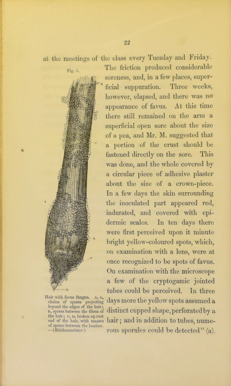 Fig. <J. at the meetings of the class every Tuesday and Friday. The friction produced considerable soreness, and, in a few places, super- ficial suppuration. Three weeks, however, elapsed, and there was no appearance of favus. At this time there still remained on the arm a superficial open sore about the size of a pea, and Mr. M. suggested that a portion of the crust should be fastened directly on the sore. This was done, and the whole covered bv a circular piece of adhesive plaster about the size of a crown-piece. In a few days the skin surrounding the inoculated part appeared red, indurated, and covered with epi- dermic scales. In ten days there were first perceived upon it minute bright yellow-coloured spots, which, on examination with a lens, were at once recognized to be spots of favus. On examination with the microscope a few of the cryptogamic jointed tubes could be perceived. In three Hair with favus fungus, a, a, , , n , chains of spores projecting days 111 OTC tllC yCHOW Spots aSSUllied a beyond the edges of the hair; .. . , . p b, spores between the fibres of distinct cupped shape, perforated by a the hair; c, i>, broken up root . . , . , ... . end of the hair, with masses hair ; and in addition to tubes, nume- of spores between the lamina?. —(Kuchenmeistcr.) rous sporules could be detected” (a).