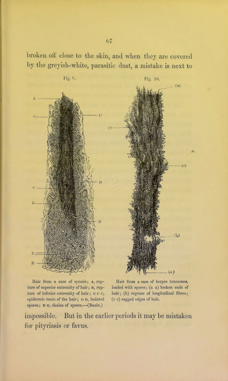 broken oil close to the skin, and when they are covered by the greyish-white, parasitic dust, a mistake is next to Fig. in. ... («) an — Hair from a case of sycosis; A, rup- ture of superior extremity of hair; B, rup- ture of inferior extremity of hair; ccc, epidermic tunic of the hair; d d, isolated spores; e e, chains of spores.—(Bazin.) Hair from a case of herpes tonsurans, loaded with spores; (a a) broken ends of hair; (b) rupture of longitudinal fibres; (c c) ragged edges of hair. impossible. But in the earlier periods it may be mistaken for pityriasis or favus.