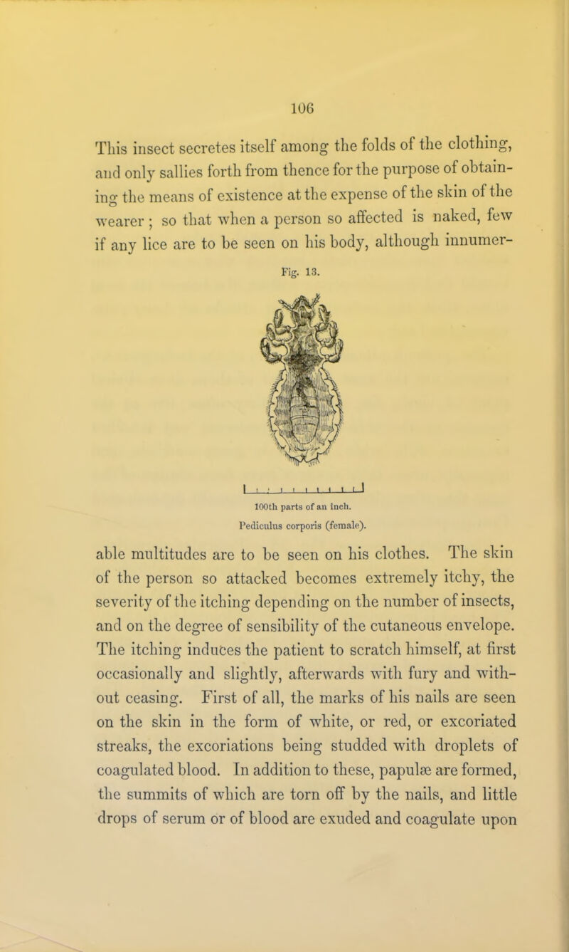 This insect secretes itself among the folds of the clothing, and only sallies forth from thence for the purpose ot obtain- ing the means of existence at the expense of the skin of the wearer j so that when a person so affected is naked, few if any lice are to be seen on his body, although innumer- Fig. 13. I : I I 1—1 I—1-_lJ 100th parts of an inch. Pediculus corporis (female). able multitudes are to be seen on his clothes. The skin of the person so attacked becomes extremely itchy, the severity of the itching depending on the number of insects, and on the degree of sensibility of the cutaneous envelope. The itching induces the patient to scratch himself, at first occasionally and slightly, afterwards with fury and with- out ceasing. First of all, the marks of his nails are seen on the skin in the form of white, or red, or excoriated streaks, the excoriations being studded with droplets of coagulated blood. In addition to these, papulae are formed, the summits of which are torn off by the nails, and little drops of serum or of blood are exuded and coagulate upon