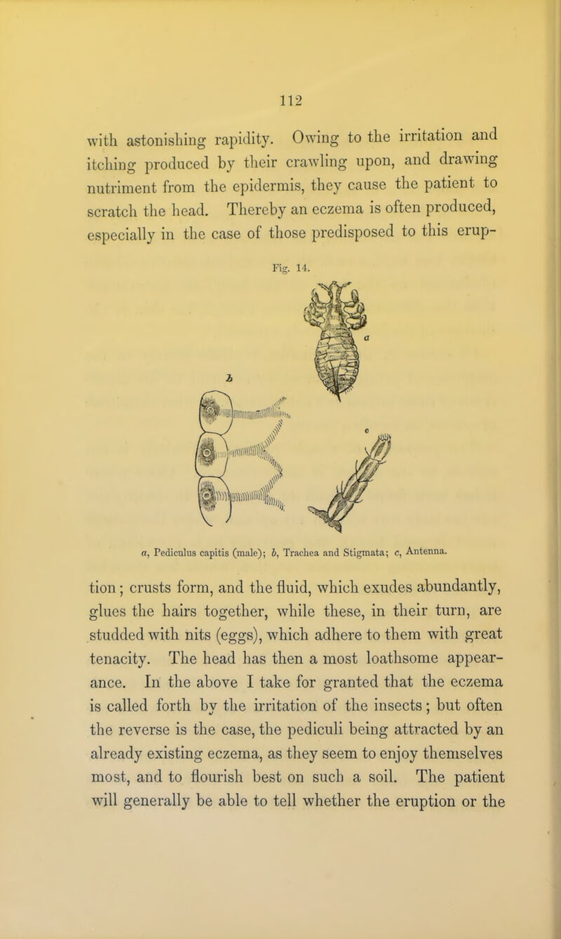 with astonishing rapidity. Owing to the irritation and itching produced by their crawling upon, and drawing nutriment from the epidermis, they cause the patient to scratch the head. Thereby an eczema is often produced, especially in the case of those predisposed to this erup- Fig. 14. a, Pedicuius capitis (male); &, Trachea and Stigmata; c, Antenna. tion; crusts form, and the fluid, which exudes abundantly, glues the hairs together, while these, in their turn, are studded with nits (eggs), which adhere to them with great tenacity. The head has then a most loathsome appear- ance. In the above I take for granted that the eczema is called forth bv the irritation of the insects; but often the reverse is the case, the pediculi being attracted by an already existing eczema, as they seem to enjoy themselves most, and to flourish best on such a soil. The patient will generally be able to tell whether the eruption or the