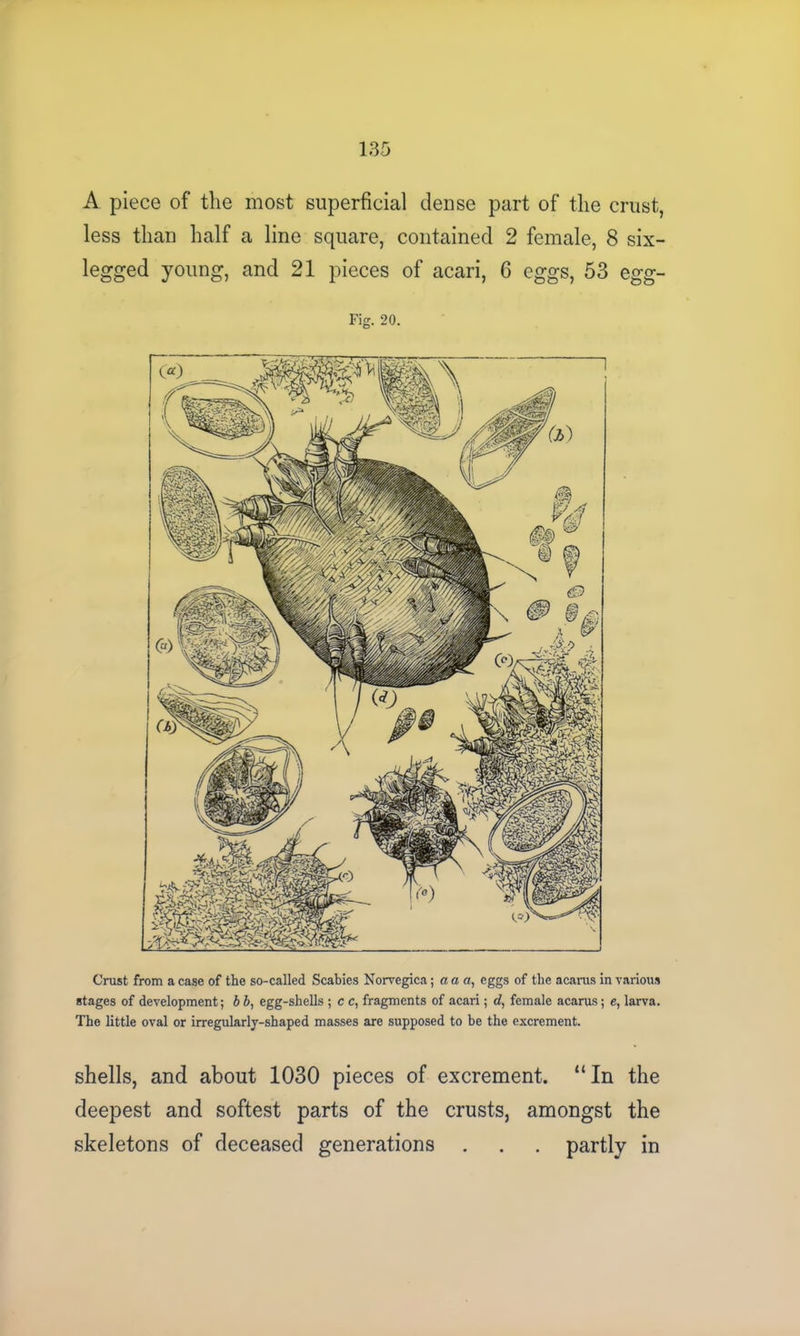 A piece of the most superficial dense part of the crust, less than half a line square, contained 2 female, 8 six- legged young, and 21 pieces of acari, 6 eggs, 53 egg- Fig. 20. Crust from a case of the so-called Scabies Norvegica; a a a, eggs of the acarus in various stages of development; b b, egg-shells ; c c, fragments of acari; d, female acarus; e, larva. The little oval or irregularly-shaped masses are supposed to be the excrement. shells, and about 1030 pieces of excrement. “ In the deepest and softest parts of the crusts, amongst the skeletons of deceased generations . . . partly in