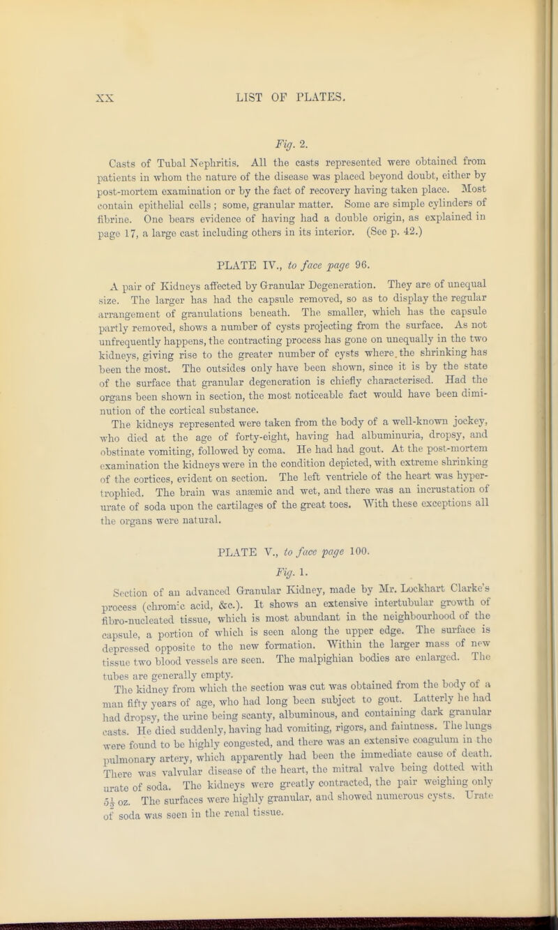 Fiff. 2. Casts of Tubal Nephritis. All the casts represented were obtained from patients in whom the nature of the disease was placed beyond doubt, either by post-mortem examination or by the fact of recovery having taken place. Most contain epithelial colls ; some, granular matter. Some are simple cylinders of iibrine. One bears evidence of having had a double origin, as explained in page 17, a large cast including others in its interior. (See p. 42.) PLATE IV., to face page 96. A pair of Kidneys affected by Granular Degeneration. They are of unequal size. The larger has had the capsule removed, so as to display the regular arrangement of granulations beneath. The smaller, which has the capsule partly removed, shows a number of cysts projecting from the surface. As not unfrequently happens, the contracting process has gone on unequally in the two kidneys, giving rise to the greater number of cysts where, the shrinking has been the most. The outsides only have been shown, since it is by the state of the surface that granular degeneration is chiefly characterised. Had the organs been shown in section, the most noticeable fact woidd have been dimi- nution of the cortical substance. The kidneys represented were taken from the body of a well-known jockey, who died at the age of forty-eight, having had albumimu-ia, dropsy, and obstinate vomiting, followed by coma. He had had gout. At the post-mortem examination the kidneys were in the condition depicted, with extreme shrinking of the cortices, evident on section. The left ventricle of the heart was hyper- trophied. The brain was ansemic and wet, and there was an incrustation of urate of soda upon the cartiLT,ges of the great toes. With these exceptions all the organs were natural. PLATE v., to face page 100. Fig. 1. Section of an advanced Granxilar Kidney, made by Mr. Lockhart Clarke's process (chromic acid, &c.). It shows an extensive intertubular growth of fibro-nucleated tissue, which is most abimdant in the neighbourhood of the capsule, a portion of which is seen along the upper edge. The surface is depressed opposite to the new formation. AVithin the larger mass of new tissue two blood vessels are seen. The malpighian bodies are enlarged. The tubes are generally empty. The kidney from which the section was cut was obtained from the body o± a man fifty years of age, who had long been subject to gout. Latterly he had had dropsy, the urine being scanty, albuminous, and containing dark granular casts. He died suddenly, having had vomiting, rigors, and faintness. The lungs ^vere foimd to be highly congested, and there was an extensive coagiilum in the piilmonary artery, which apparently had been the immediate cause of death. There was valvular disease of the heart, the mitral valve being dotted with m-ate of soda. The kidneys were greatly contracted, the pair weighing only 51 oz. The surfaces were highly granidar, and sliowed numerous cysts. Urate of soda was seen in the renal tissue.