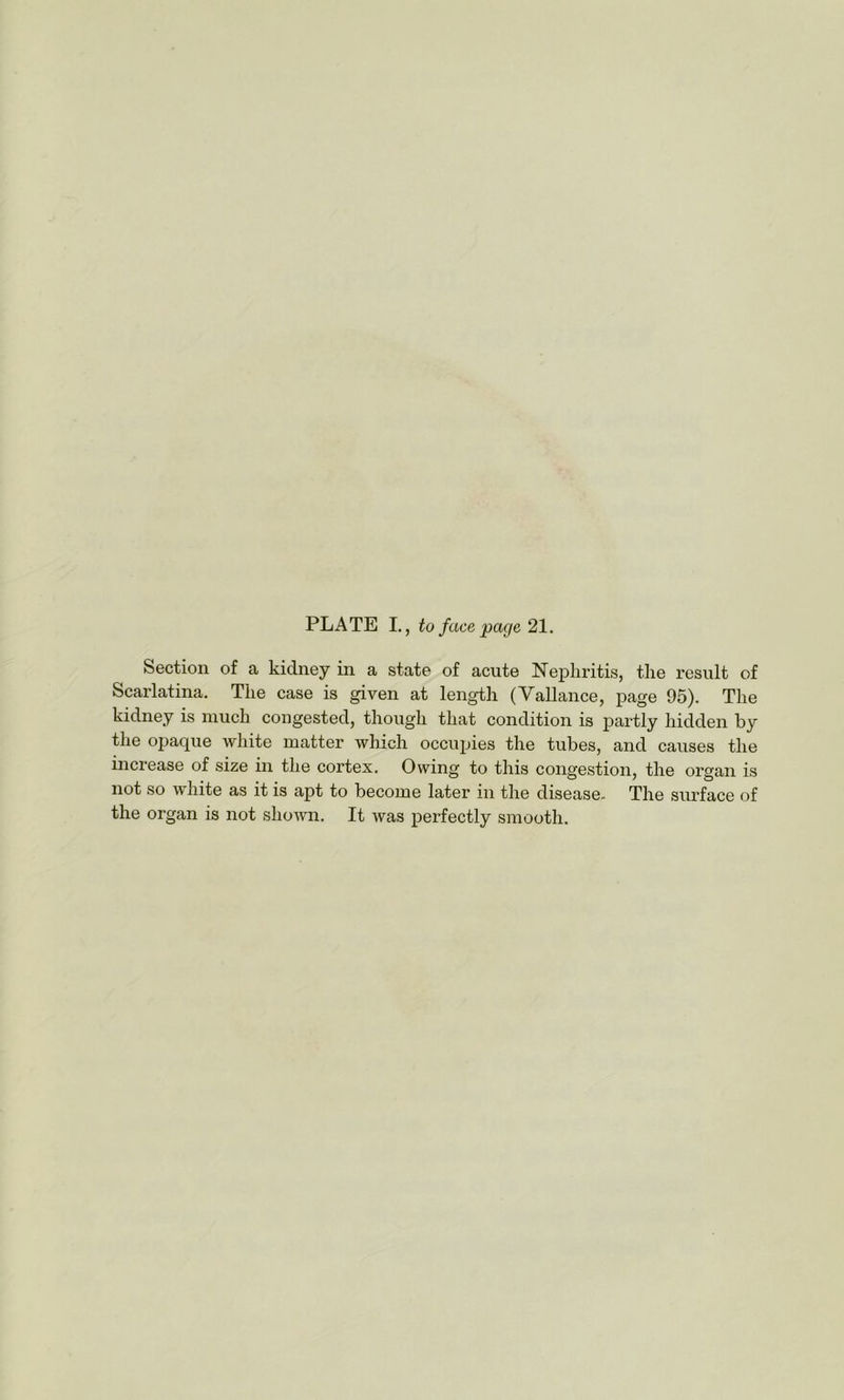 Section of a kidney in a state of acute Nephritis, the result of Scarlatina. The case is given at length (Vallance, page 95). The kidney is much congested, though that condition is partly hidden by the opaque white matter which occupies the tubes, and causes the increase of size in the cortex. Owing to this congestion, the organ is not so white as it is apt to become later in the disease- The surface of the organ is not shown. It was perfectly smooth.