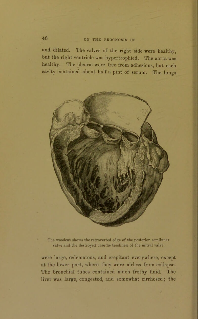 ON THE PROGNOSIS IN and dilated. The valves of the right side were healthy, but the right ventricle was hypertrophied. The aorta was healthy. The pleune were free from adhesions, but each cavity contained about half a pint of serum. The lungs i The woodcut shows the retrovertcd edge of the posterior semilunar valve and the destroyed chordae tendiiieae of the mitral valve. were large, oedematous, and crepitant everywhere, except at the lower part, where they were airless from collapse. The bronchial tubes contained much frothy fluid. The liver was large, congested, and somewhat cirrhosed; the
