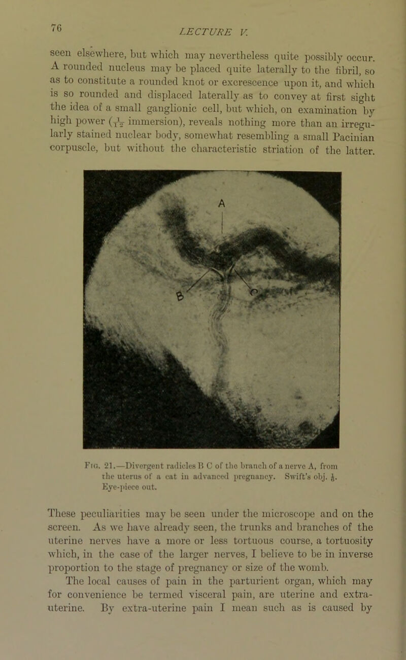 seen elsewhere, but which may nevertheless quite possibly occur. A rounded nucleus may be placed quite laterally to the fibril, so as to constitute a rounded knot or excrescence upon it, and which is so rounded and displaced laterally as to convey at first sight the idea of a small ganglionic cell, but which, on examination by high power (XV immersion), reveals nothing more than an irregu- larly stained nuclear body, somewhat resembling a small Pacinian corpuscle, but without the characteristic striation of the latter. Fkj. 21.—Divergent radicles B C of the branch of a nerve A, from the uterus of a cat in advanced pregnancy. Swift’s obj. J. Eye-piece out. These peculiarities may be seen under the microscope and on the screen. As we have already seen, the trunks and branches of the uterine nerves have a more or less tortuous course, a tortuosity which, in the case of the larger nerves, I believe to be in inverse proportion to the stage of pregnancy or size of the womb. The local causes of pain in the parturient organ, which may for convenience be termed visceral pain, are uterine and extra- uterine. By extra-uterine pain I mean such as is caused by