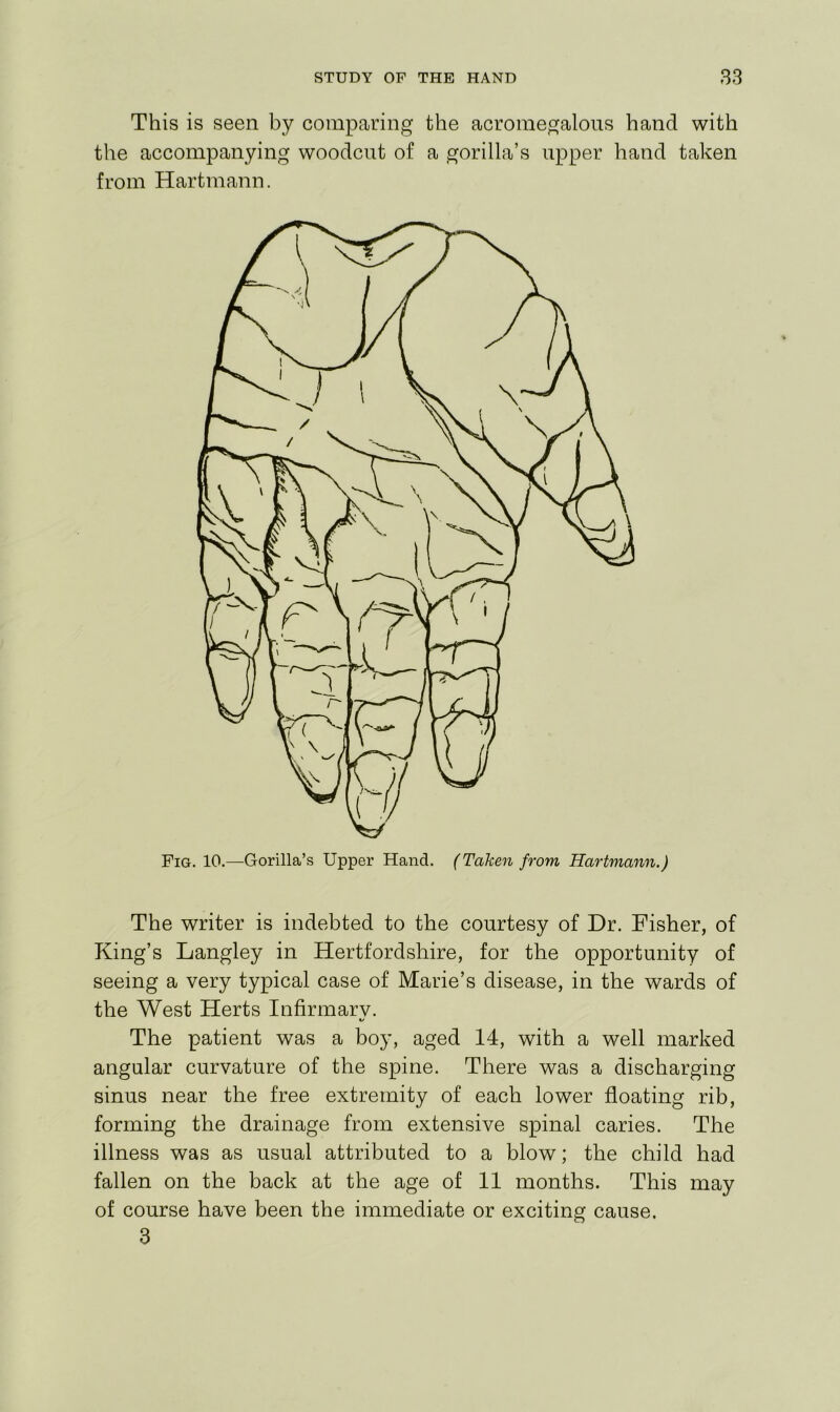 This is seen by comparing the acroinegalons hand with the accompanying woodcut of a gorilla’s upper hand taken from Hartmann. Fig. 10.—Gorilla’s Upper Hand. (Taken from Hartmann.) The writer is indebted to the courtesy of Dr. Fisher, of King’s Langley in Hertfordshire, for the opportunity of seeing a very typical case of Marie’s disease, in the wards of the West Herts Infirmary. «/ The patient was a boy, aged 14, with a well marked angular curvature of the spine. There was a discharging sinus near the free extremity of each lower floating rib, forming the drainage from extensive spinal caries. The illness was as usual attributed to a blow; the child had fallen on the back at the age of 11 months. This may of course have been the immediate or exciting cause. 3