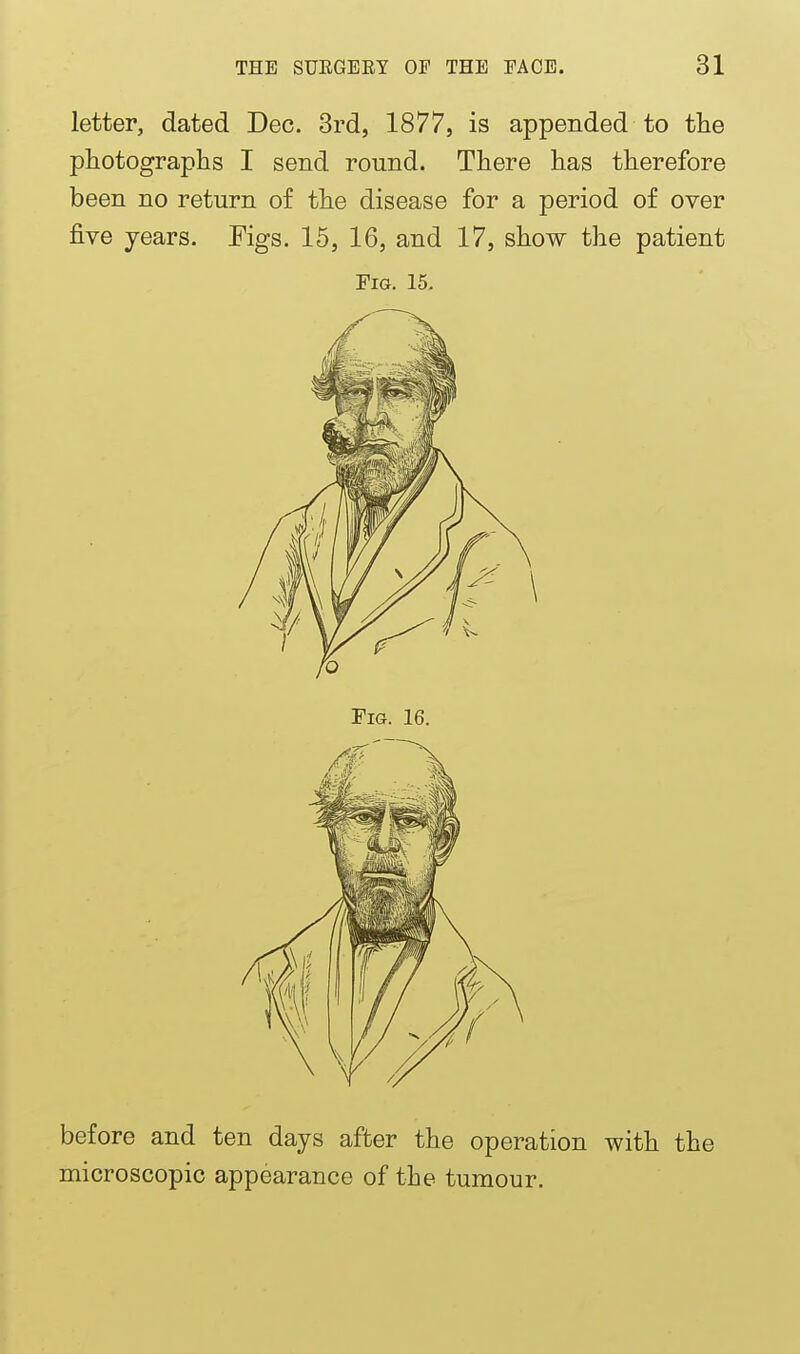 letter, dated Dec. 3rd, 1877, is appended to the photographs I send round. There has therefore been no return of the disease for a period of over five years. Figs. 15, 16, and 17, show the patient Fig. 15. before and ten days after the operation with the microscopic appearance of the tumour.
